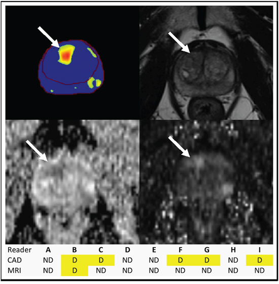 Figure 2: Benefit of CAD in TZ tumor identification.