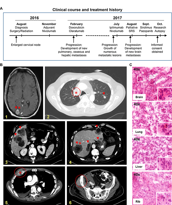 Figure 1: Research autopsy of a patient with metastatic IDCS.