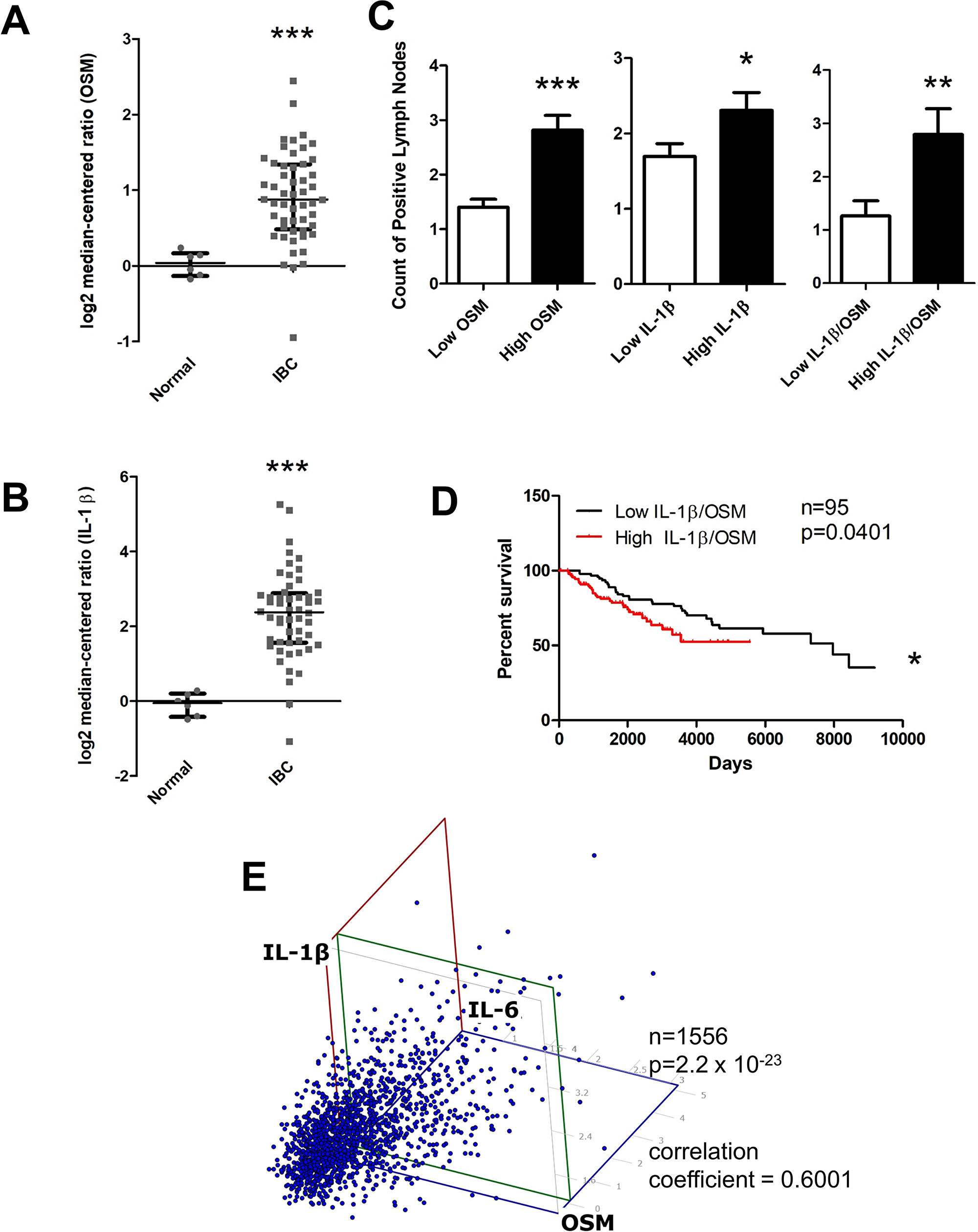 OSM and IL-1β expression is higher in invasive breast cancer compared to normal tissue and correlates with higher lymph node metastasis, decreased survival, and IL-6 levels.