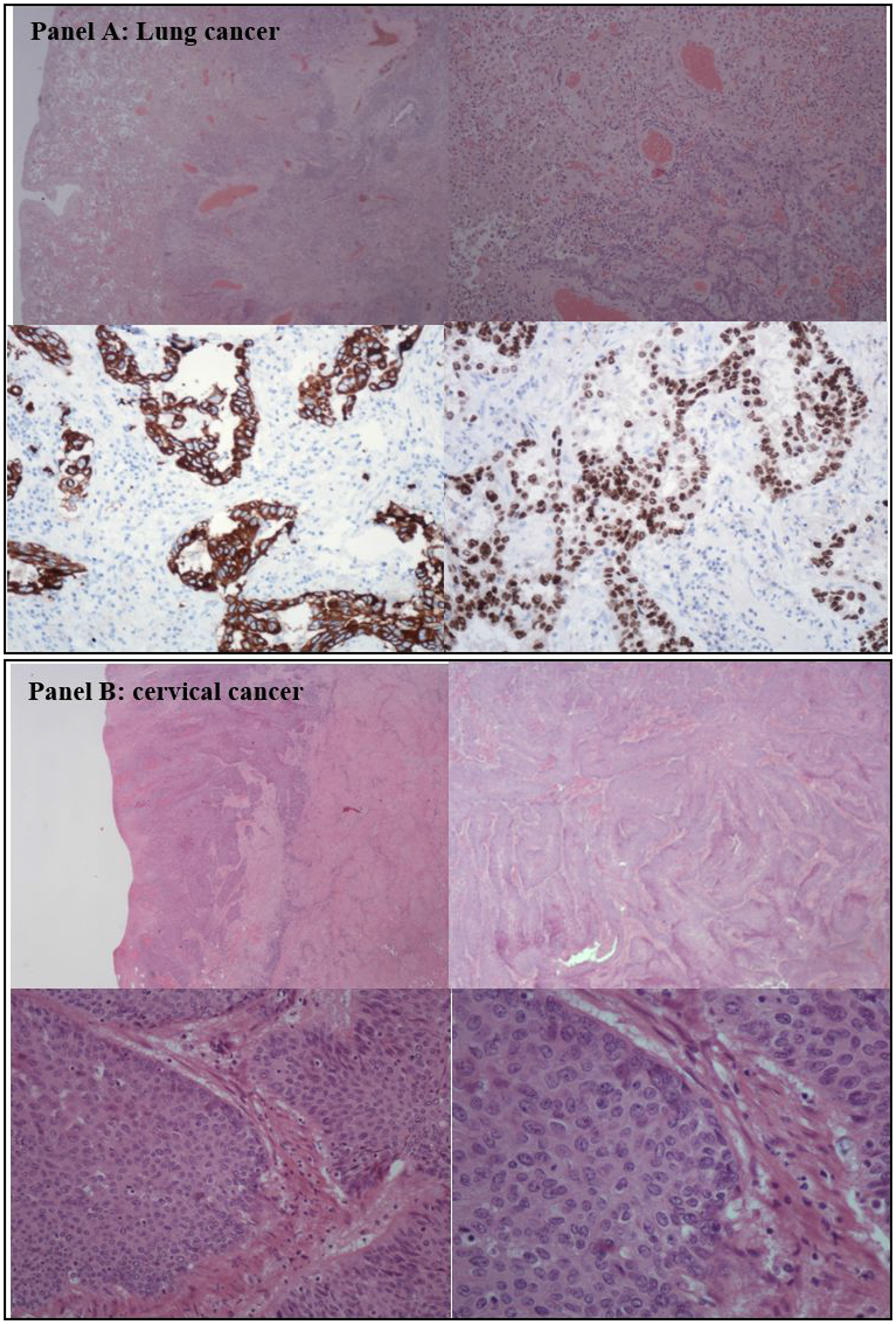 Histological analysis of the lung and cervical cancer.