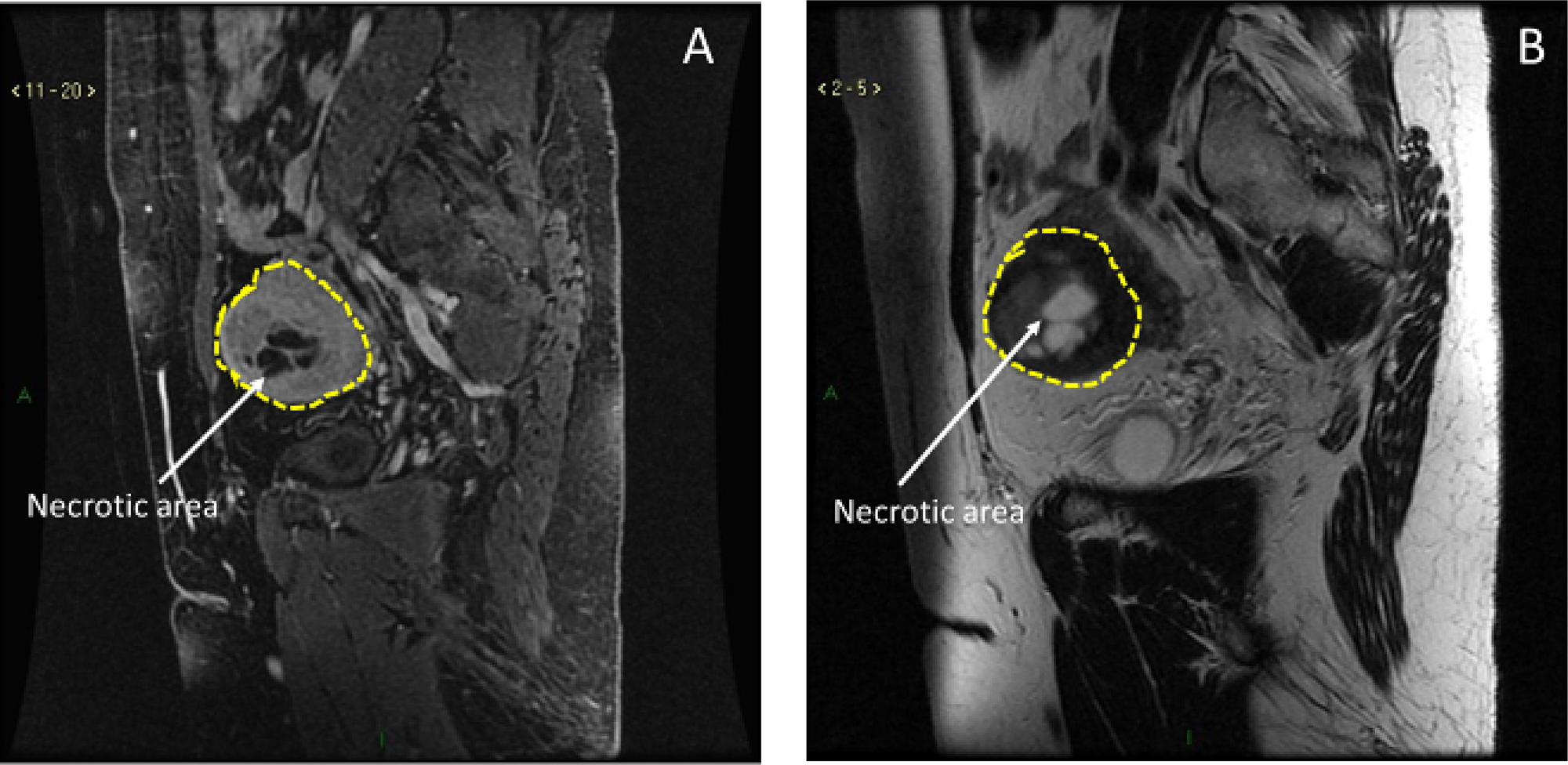 MRI characteristics of uLMS.