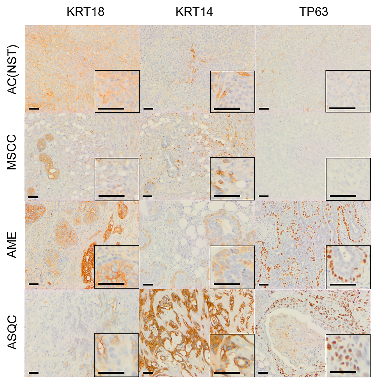 Immunohistochemical staining of olaparib-resistant tumours of different phenotypes in the Brca2/p53-mutant mammary tumour model.