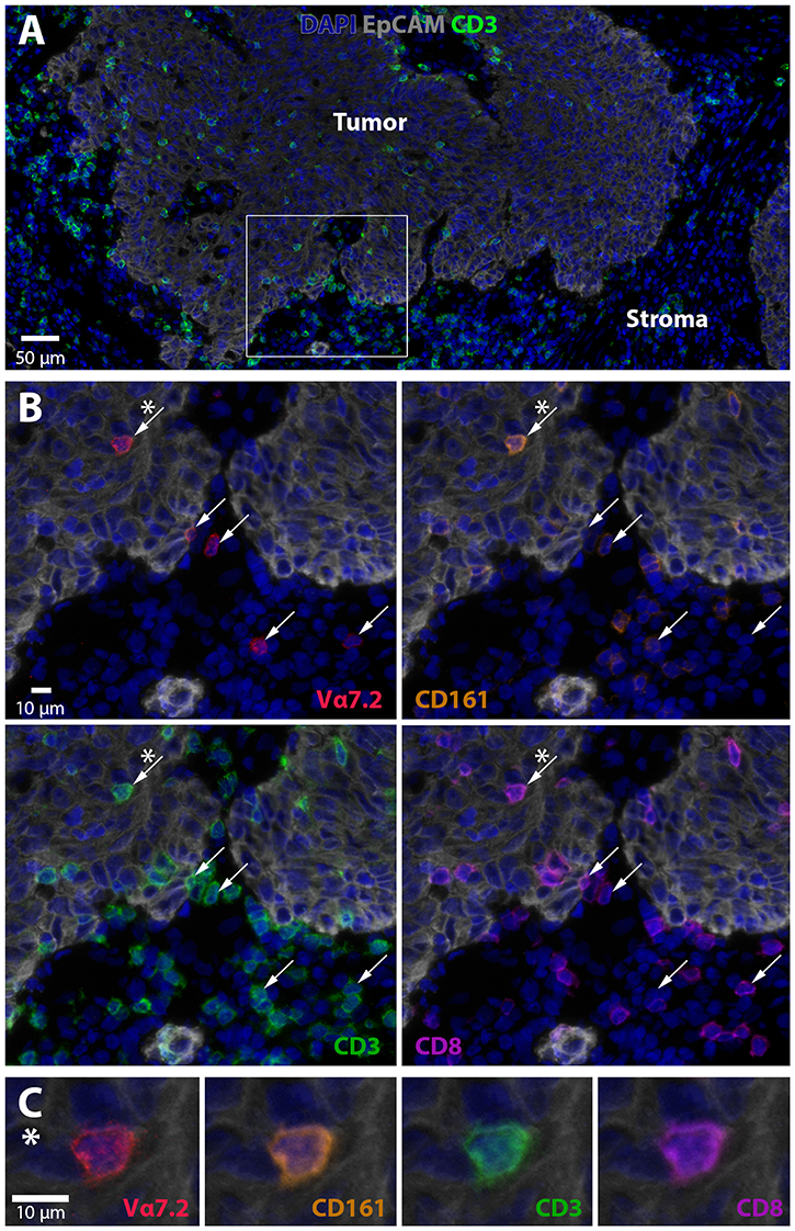 MAIT cell localization in colon tumors.