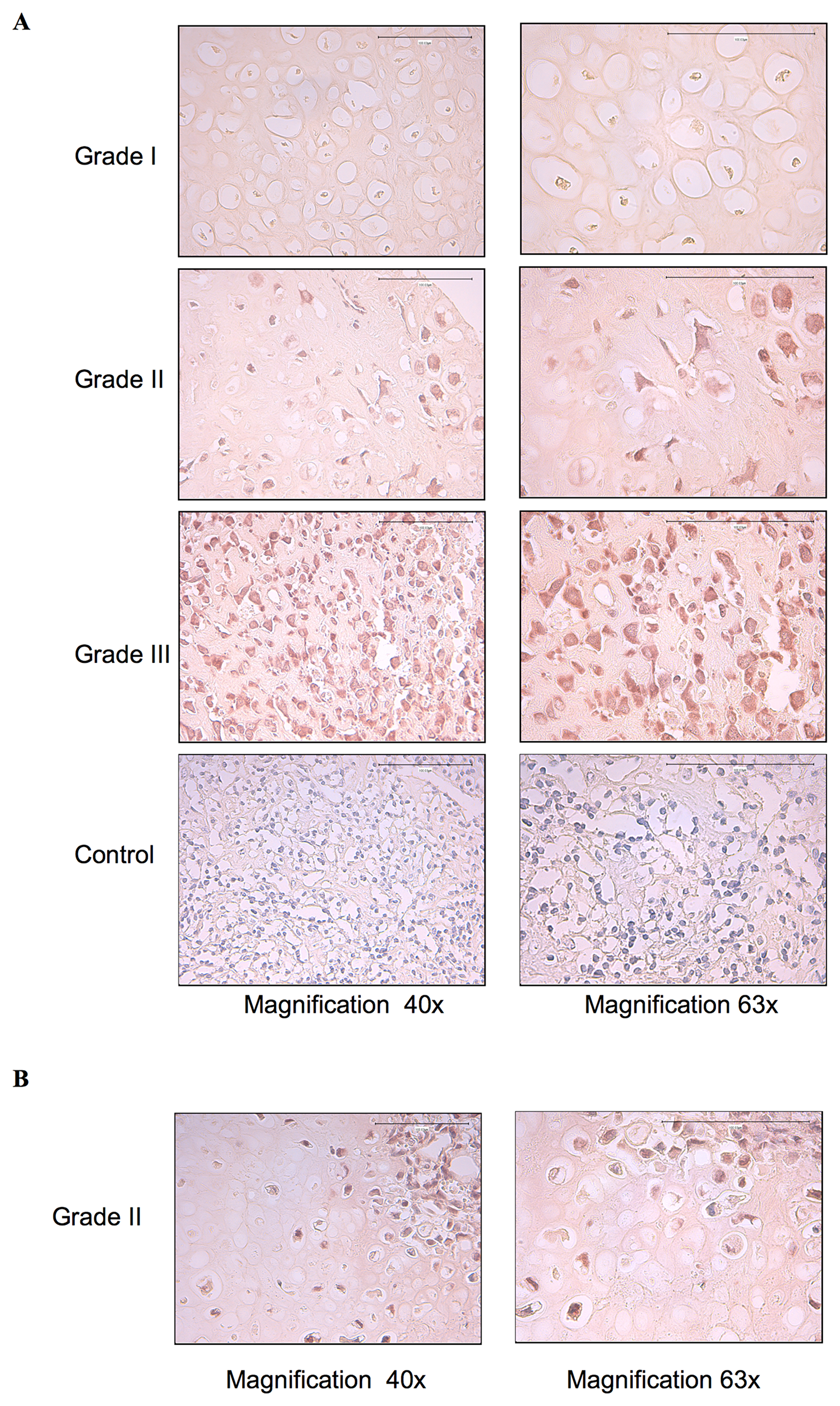 EGFR is constitutively activated in high-grade chondrosarcoma tumor biopsies.