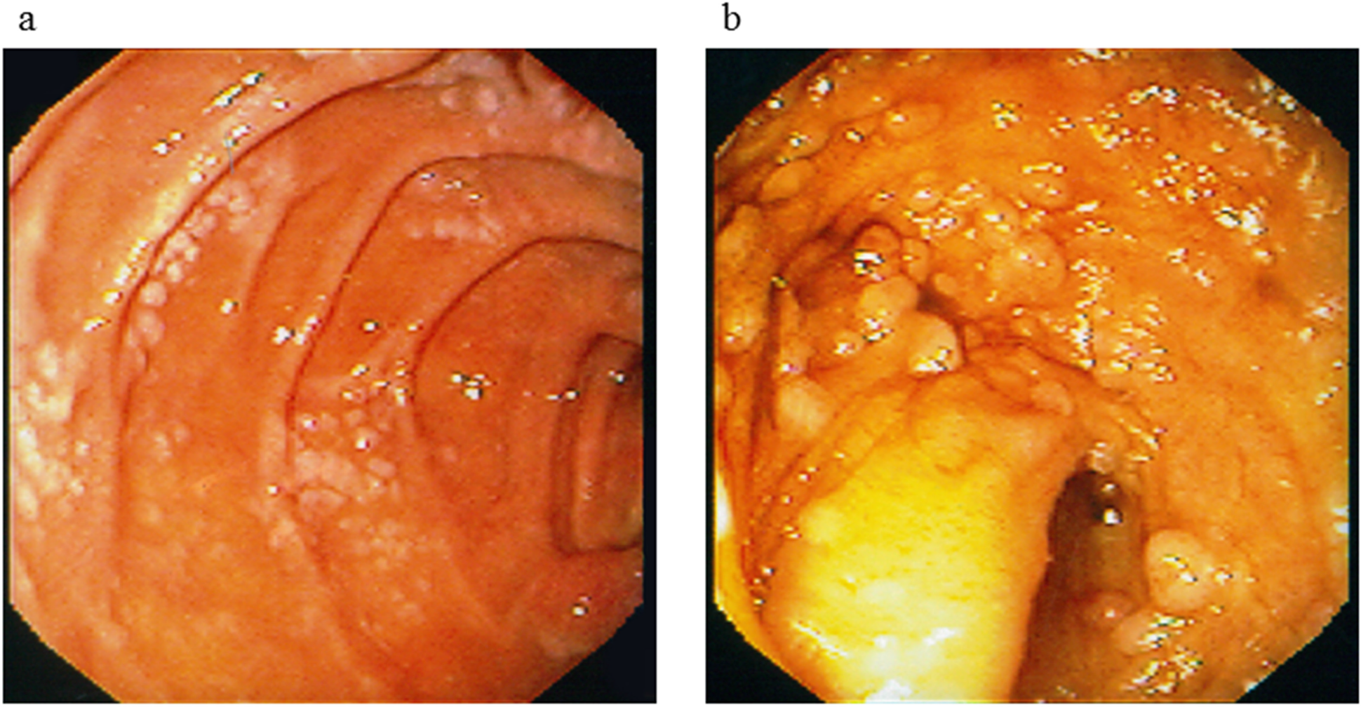 Endoscopic findings at initial presentation.