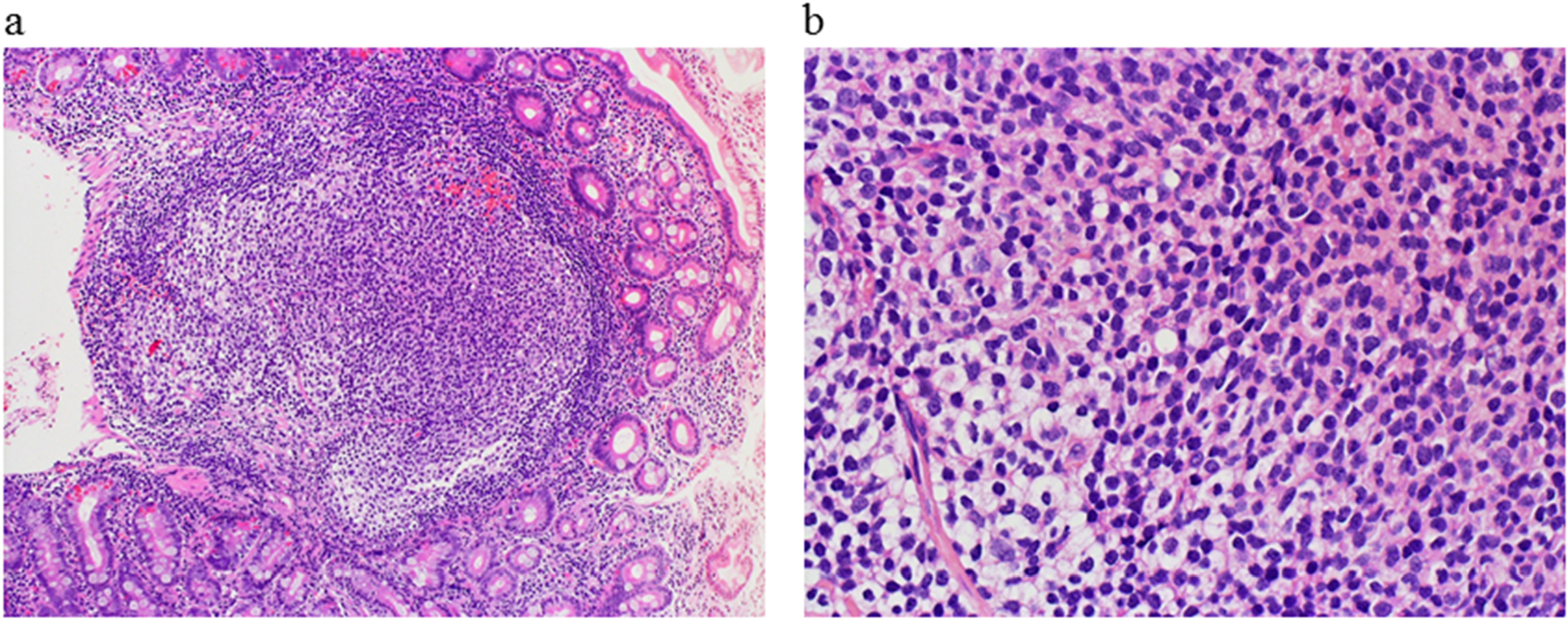Histological findings of the duodenal tumor at diagnosis.