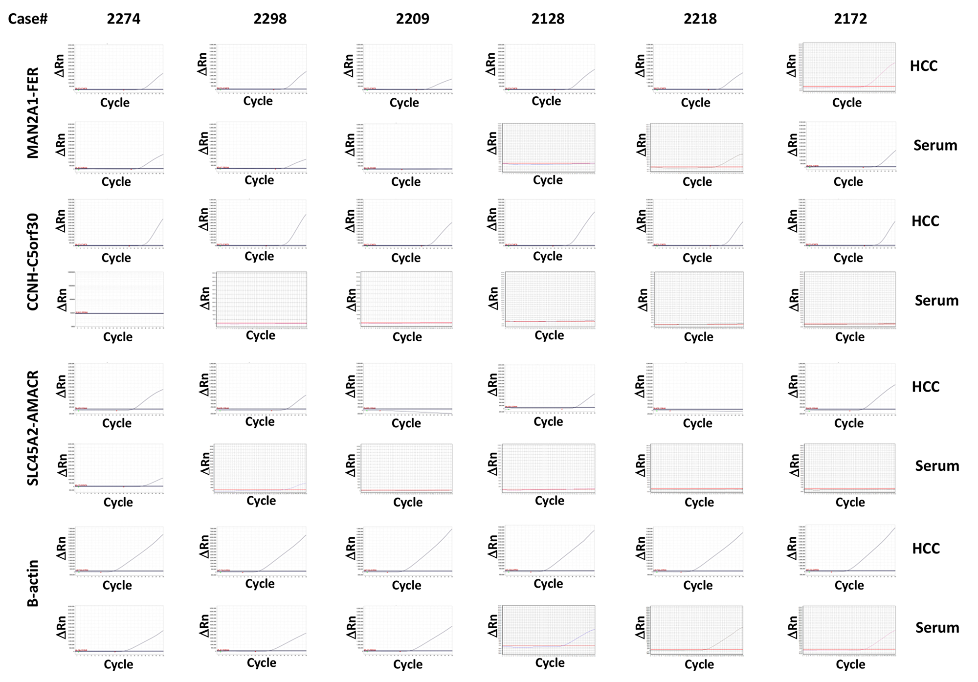Detection of MAN2A1-FER, CCNH-C5orf30 and SLC45A2-AMACR in HCC samples and the corresponding serum samples