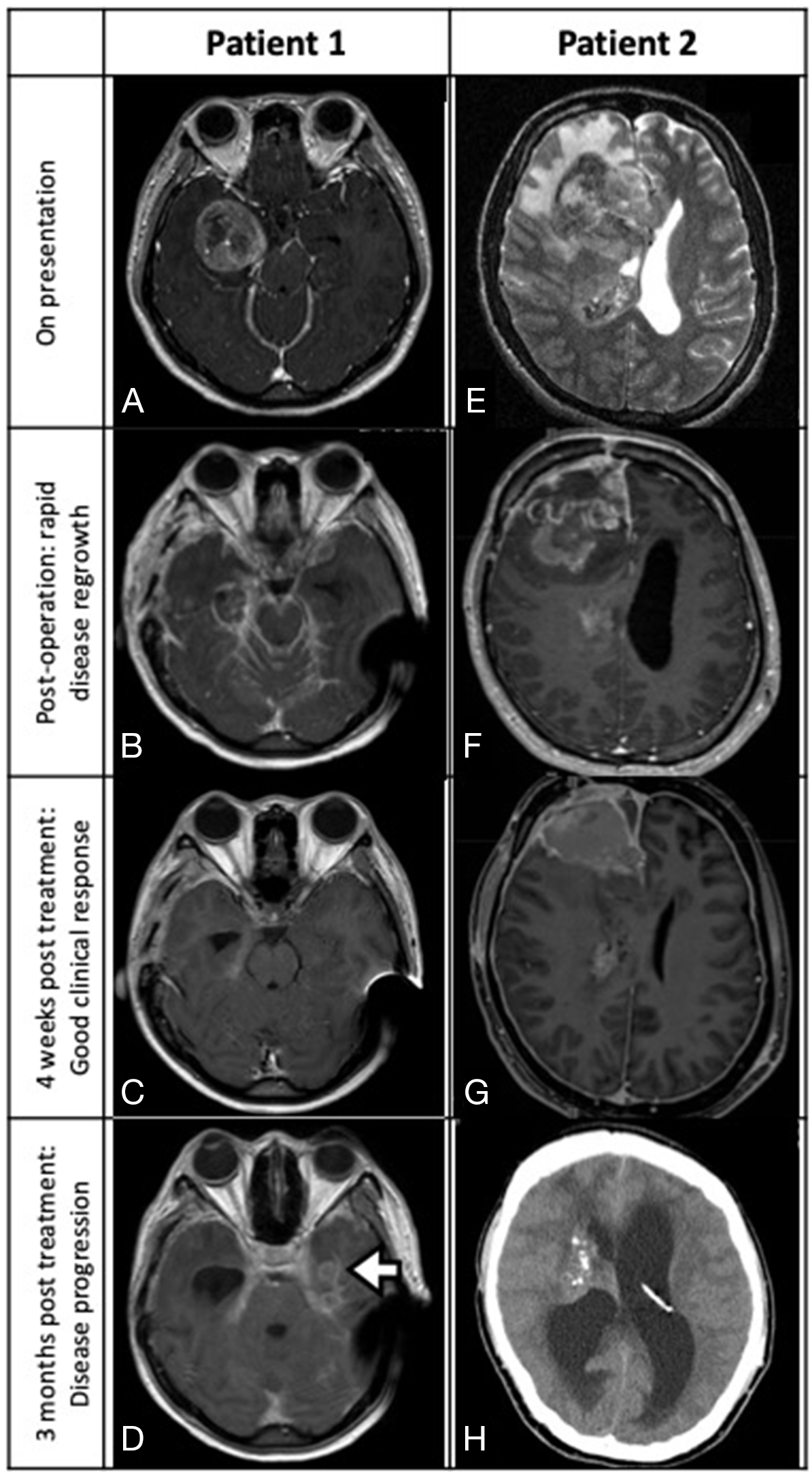 Patient 1 (A-D): MRI depicting a right temporal glioblastoma with ambient cistern LMS (A, axial T1-weighted contrast-enhanced sequence). Post-near total resection three-week MRI showing local recurrence with diffuse LMS (B, axial). After receiving four weeks of dabrafenib and trametinib, significant tumor regression was noted (C, axial MRI). Three months after starting combined target therapy, LMS with a new left temporal lesion was detected (D, axial MRI; white arrow, multifocal tumor recurrence). Patient 2 (E-H): MRI scan revealing a right frontal glioblastoma with spread into the body of the right lateral ventricle (E, axial T2-weighted sequence; white arrowhead, ventricular tumor). Post-subtotal resection MRI showing rapid regrowth of tumor at surgical cavity and the development of communicating hydrocephalus (F, sagittal T1-weighted contrast-enhanced sequence). Significant tumor regression observed four weeks after starting vemurafenib (G, axial T1 contrast enhanced MRI). Disease rapidly progressed after stopping BRAF inhibitor and developed severe hydrocephalus (H, plain CT).