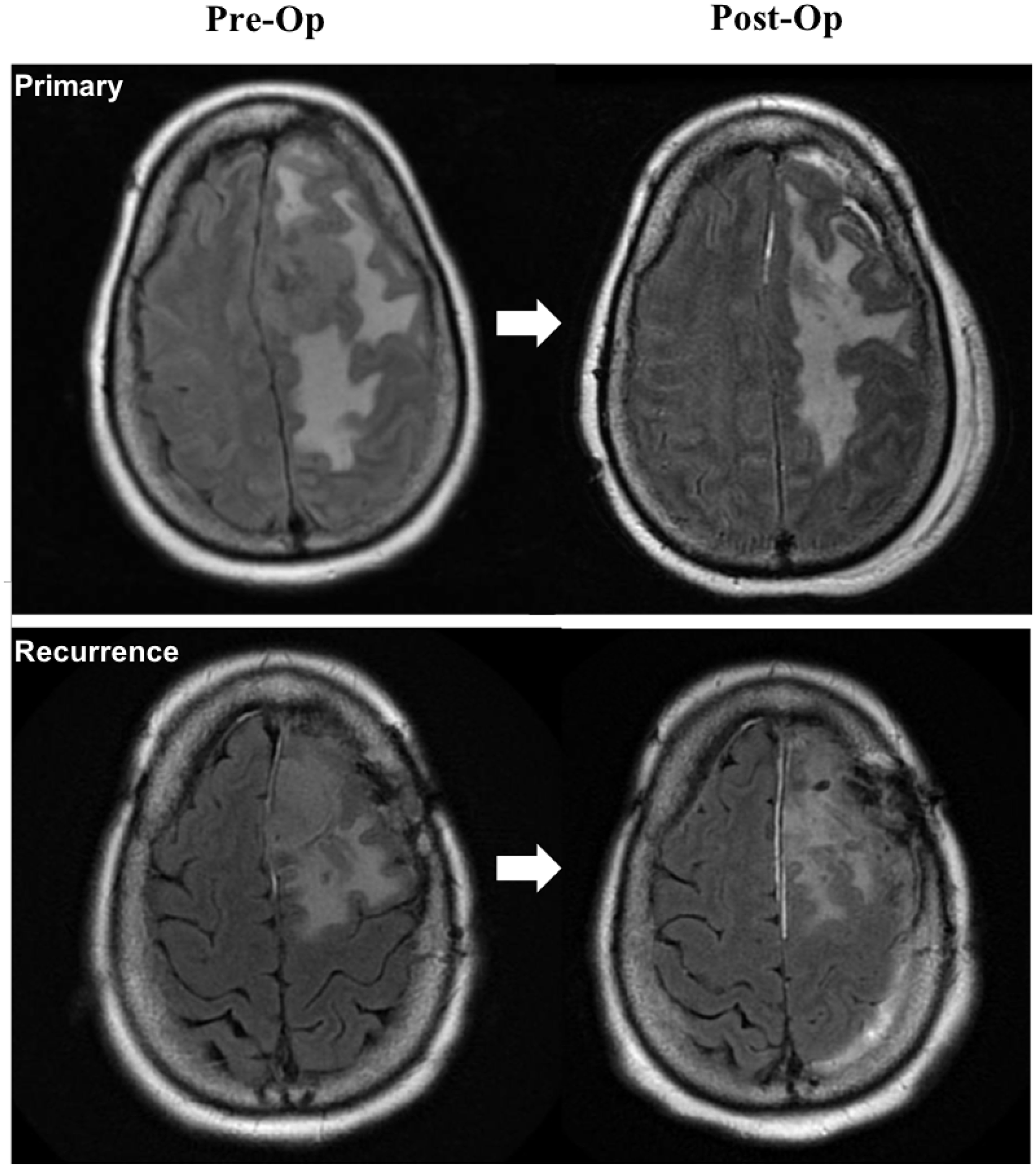 T2 FLAIR magnetic resonance (MR) imaging of a representative patient with an NF2 mutation positive WHO grade II meningioma (frameshift deletion at locus chr22:30074229) showing large tumor volume with vasogenic edema for the primary tumor (top) and a recurrence (bottom). Left images depict preoperative MR imaging and right images are postoperative MR imaging. Recurrent meningioma was found to have an ARID1A nonsense mutation at locus chr1:27101099 in addition to the NF2 frameshift deletion.