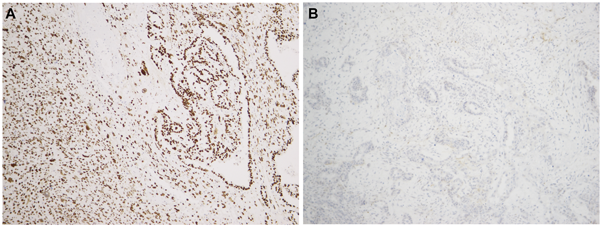 p53 immunostaining in two uterine carcinosarcomas showing the two aberrant patterns, i.e. diffuse strong expression and entirely negative expression in panels (A and B), respectively.