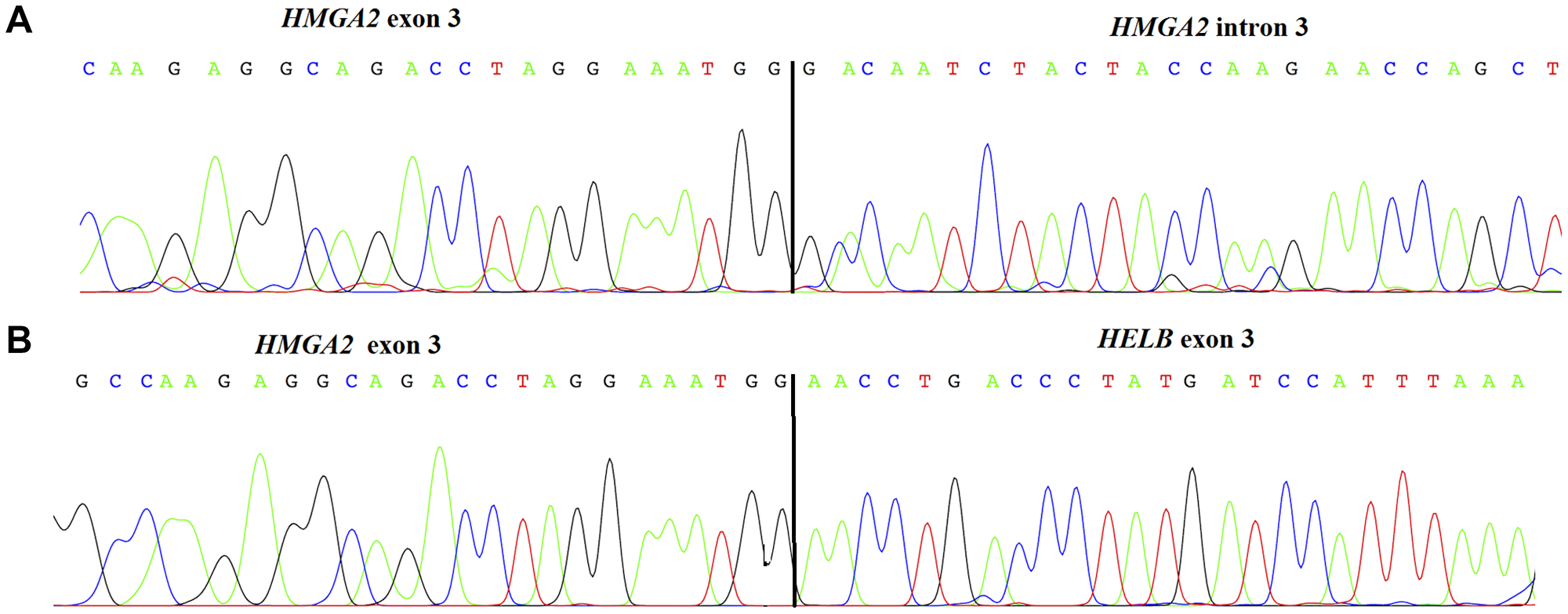 Chromatogram and sequence of HMGA2 truncated transcript found in an uterine carcinosarcoma (case 4) showing the junction between exon 3 and the intronic region (A). Chromatogram of HMGA2 truncated transcript found in a uterine carcinosarcomas (case 25) showing a fusion between HMGA2 and HELB (B).