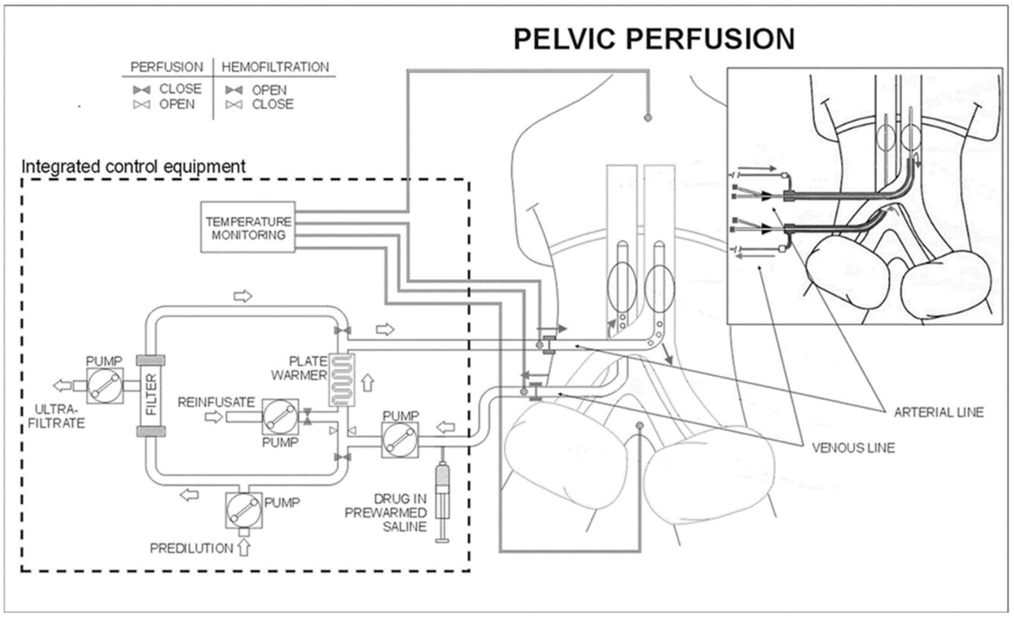 Schematic representation of the surgical and percutaneous hypoxic pelvic perfusion (HPP) procedures, with chemofiltration