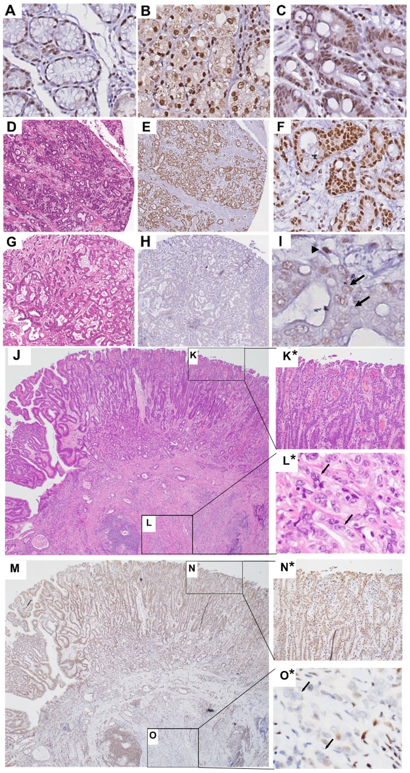 Representative nuclear FLI1 IHC staining in normal, IM and gastric adenocarcinoma tissues