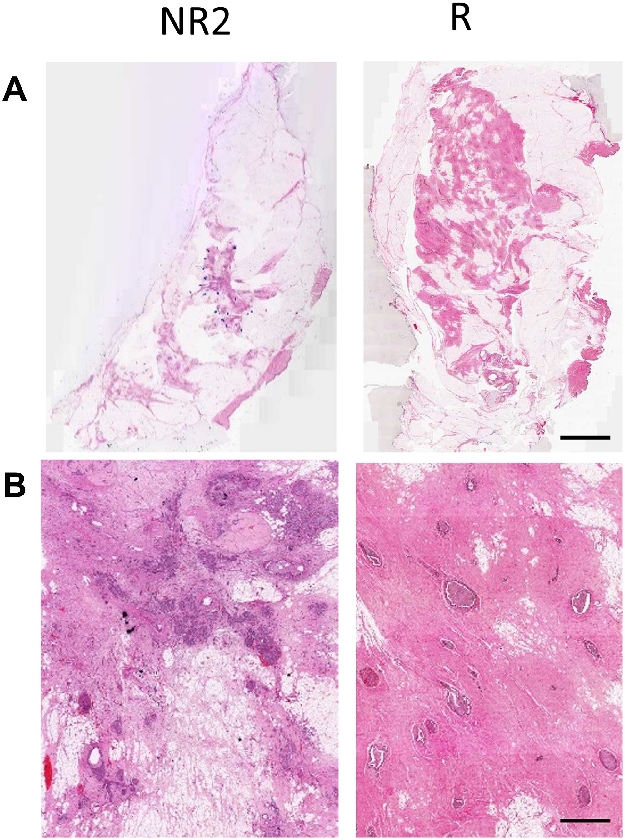 (A) H & E stained histology images of the excised breast specimen after resection. (B) High-magnification images. Scale bars: H & E low magnification – 1 cm, H & E high magnification – 100 μm.