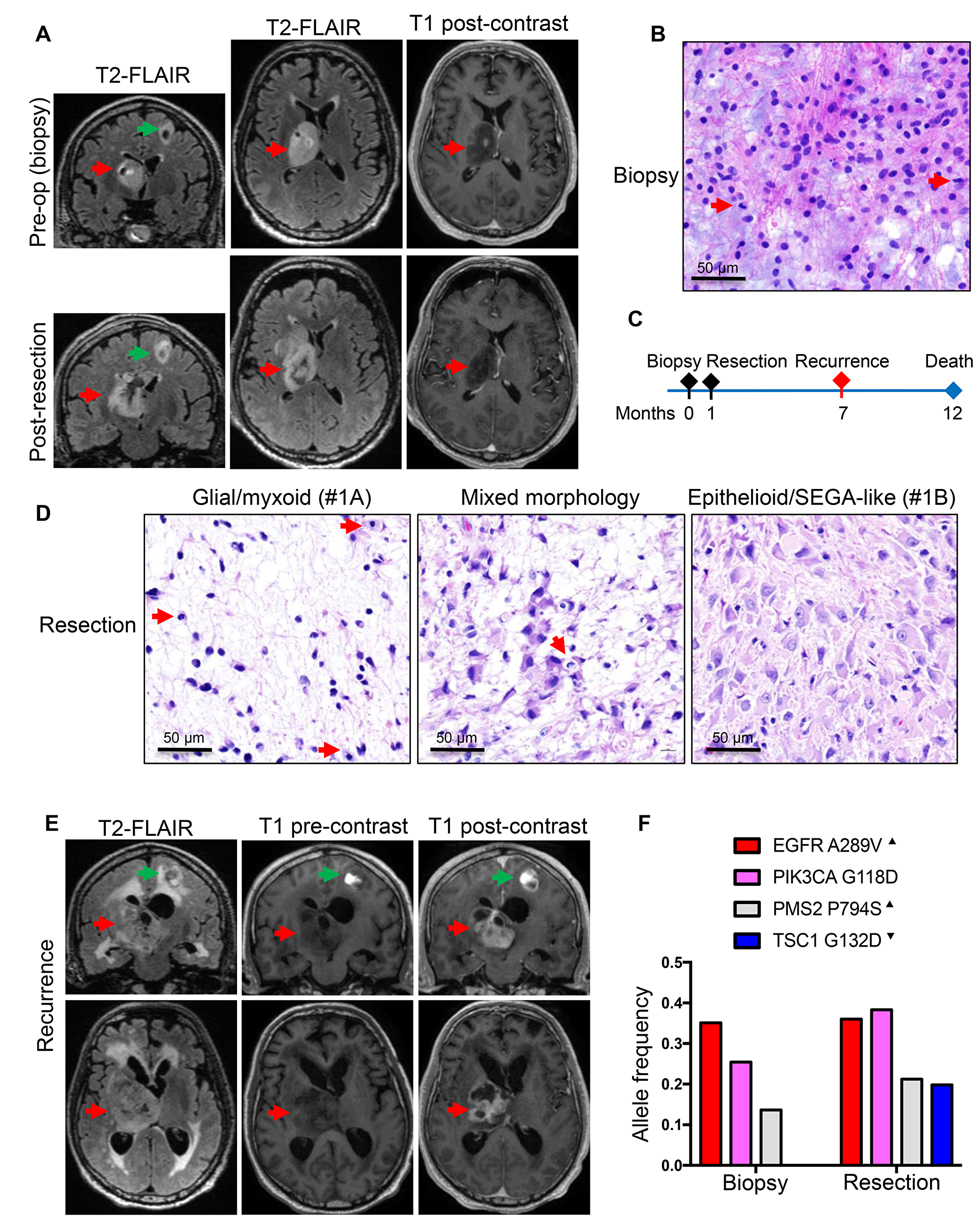 Patient 1: Aggressive thalamic anaplastic astrocytoma with TSC1 mutation and 1-year survival.