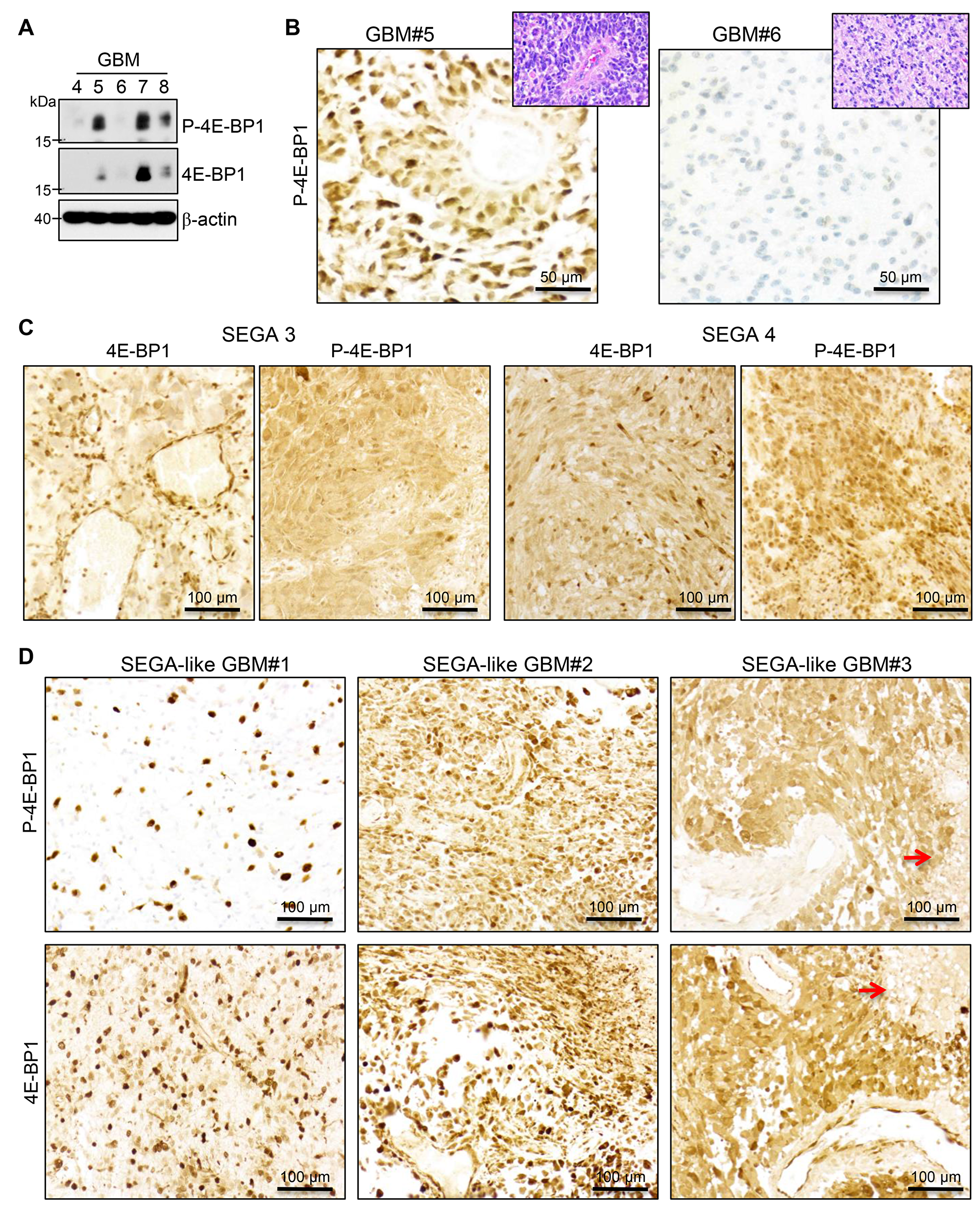MTOR activation in SEGA and SEGA-like glioblastoma.