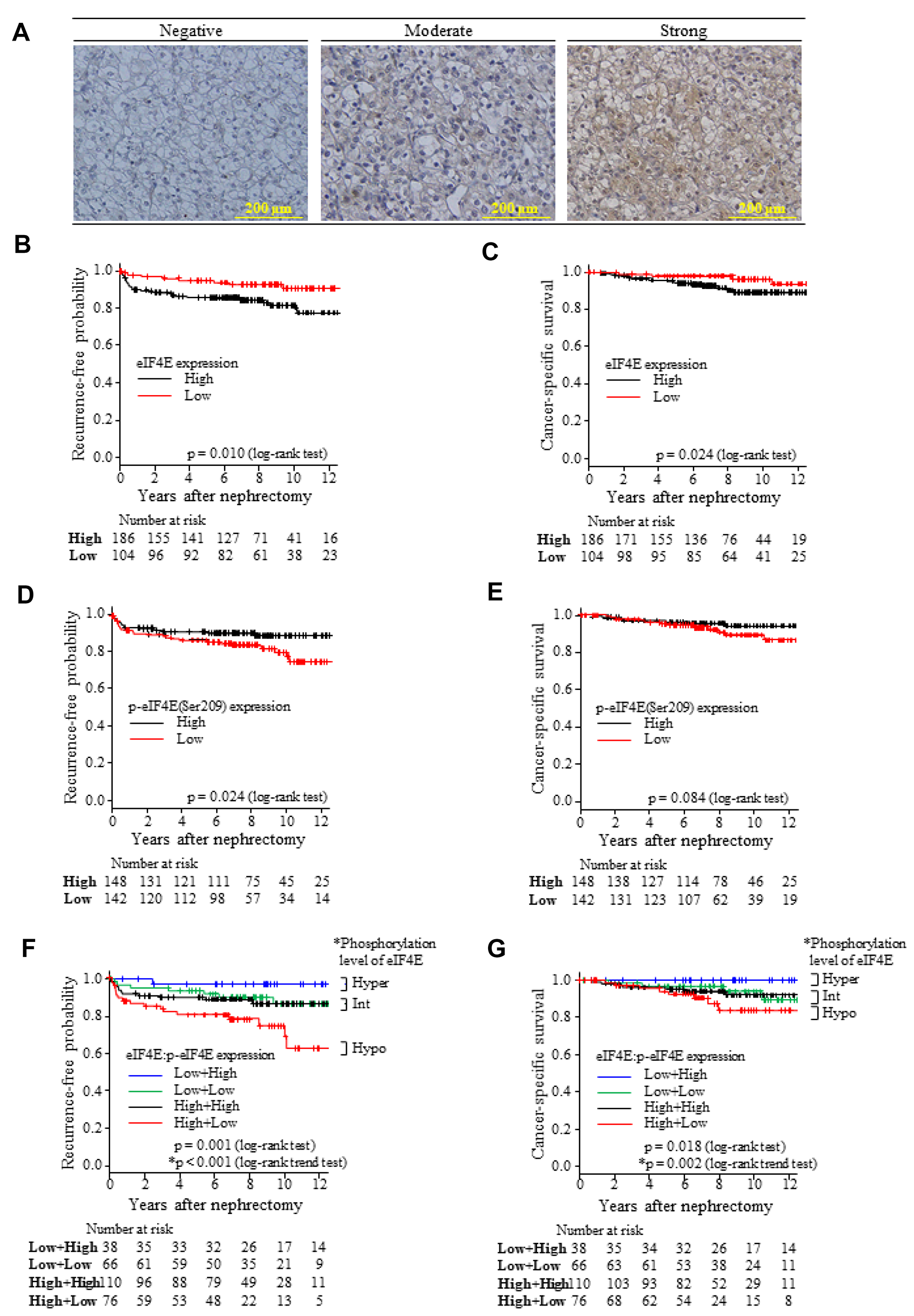 Grading of eIF4E and p-eIF4E(Ser209) expression levels by IHC semi-quantitation and their impact on recurrence-free and CSS intervals.