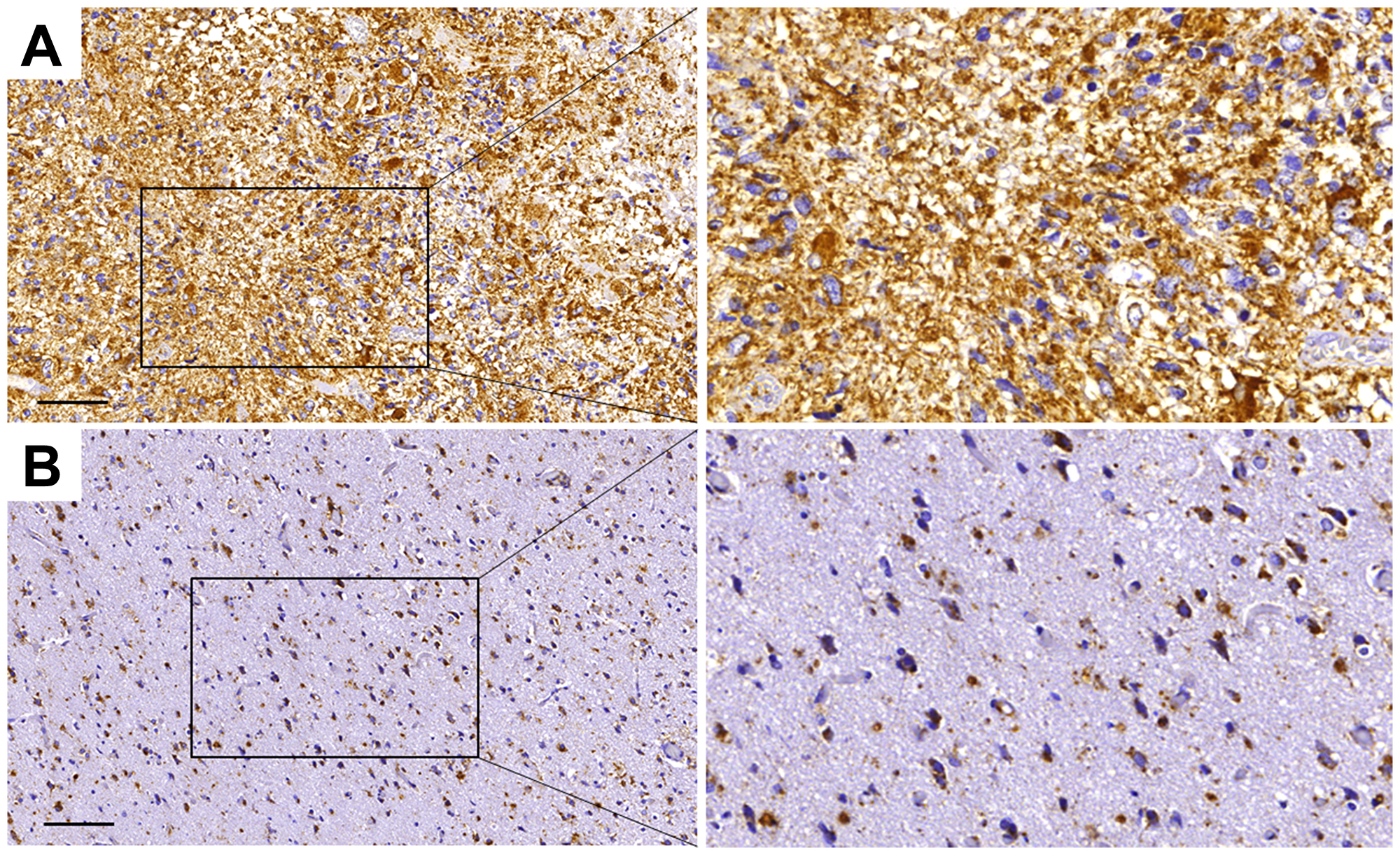 Paucimannose is strongly upregulated in grade IV glioblastoma in humans.