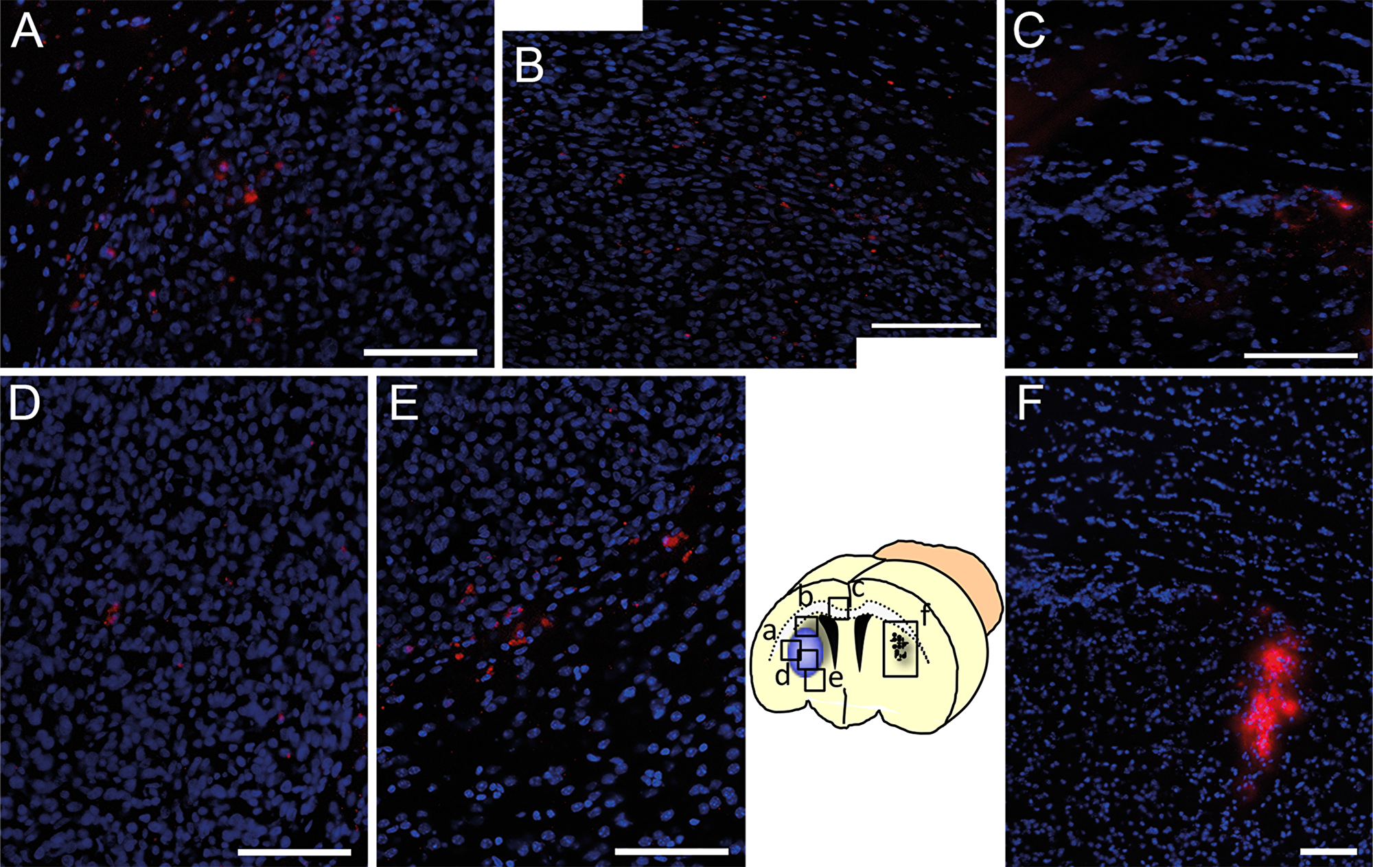 Tumor targeted in vivo migration of DiI-labeled MSCs (red) seven days after stereotactic injection into the contralateral hemisphere (F, injection site) of a growing U87 glioblastoma xenograft. Within seven days DiI-MSCs were found in the tumor area (A and B) after migration towards the glioblastoma in the contralateral hemisphere via the corpus callosum (C). Even in distant parts of the tumor DiI-labeled MSCs were found intratumorally (D) or peritumorally (E) whereas no MSCs were found in other regions of the brain. Scale Bars: 100 μm.