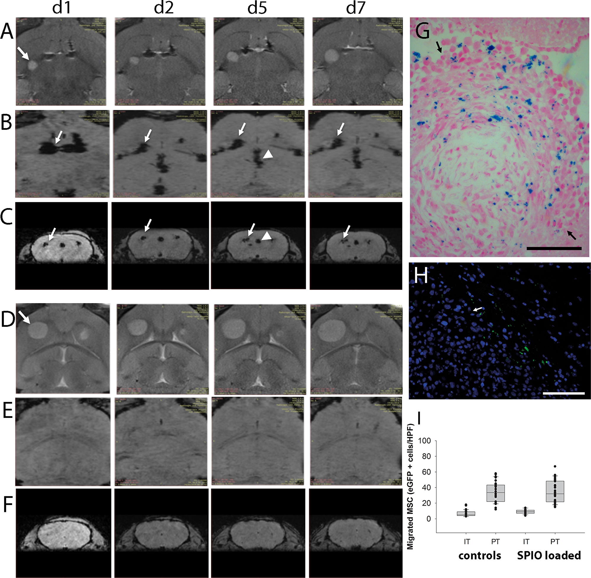 In vivo MR-imaging of tumor targeted migration of human MSCs towards intracerebral U87 glioblastoma xenografts (A–C = SPIO-loaded MSCs, D–F = control animals with non-loaded MSCs). Axial sections of T2-weighted MR images demonstrate glioblastoma growth (arrow) from day one (d1) to day seven (d7) after MSC injection into the contralateral hemisphere (A, d1-d7; D, d1-d7). Signal voids in axial (B) and in coronal (C) sections of SW images indicated SPIO-labeled MSCs migrating from the injection site (arrows) via the corpus callosum towards the tumor site over time. Signal voids in the ventricular system (arrowhead, e.g. D/d5 and C/d5) indicated MSC presence and (G) histological analysis confirmed tumor spread into the ventricular system where presence of SPIO-loaded MSCs within the tumor mass (arrows) was confirmed by Prussian blue staining (blue). (E, F) Corresponding SW images of control mice which received MSC without SPIO loading did not display similar signal voids. (H) Tumor tropism of human SPIO-loaded MSCs was furthermore confirmed by the presence of GFP-positive MSCs at the contralateral tumor site (arrow = tumor border). (I) Histological quantification of SPIO-loaded and non-loaded GFP-positive MSCs within the tumor and the peritumoral area. Scale Bars: 100 μm.