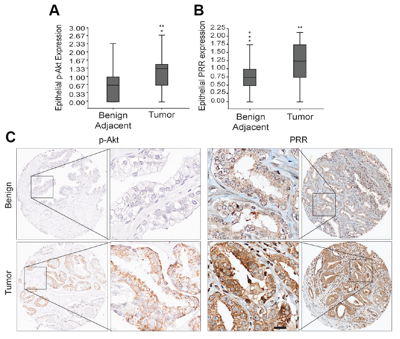 Analysis of p-Akt and PRR expression in prostate cancer tissue microarrays.