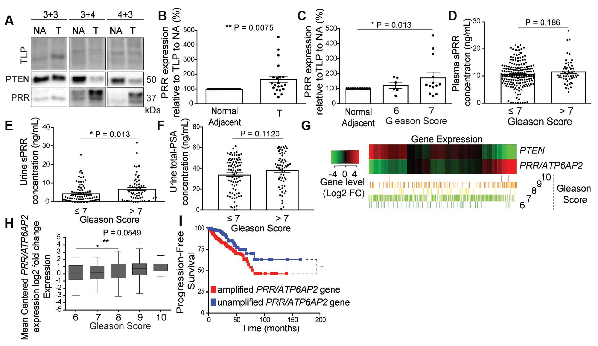 PRR expression increases in tumor tissue, correlates with Gleason score, and sPRR is elevated in urine of patients with aggressive prostate cancer.