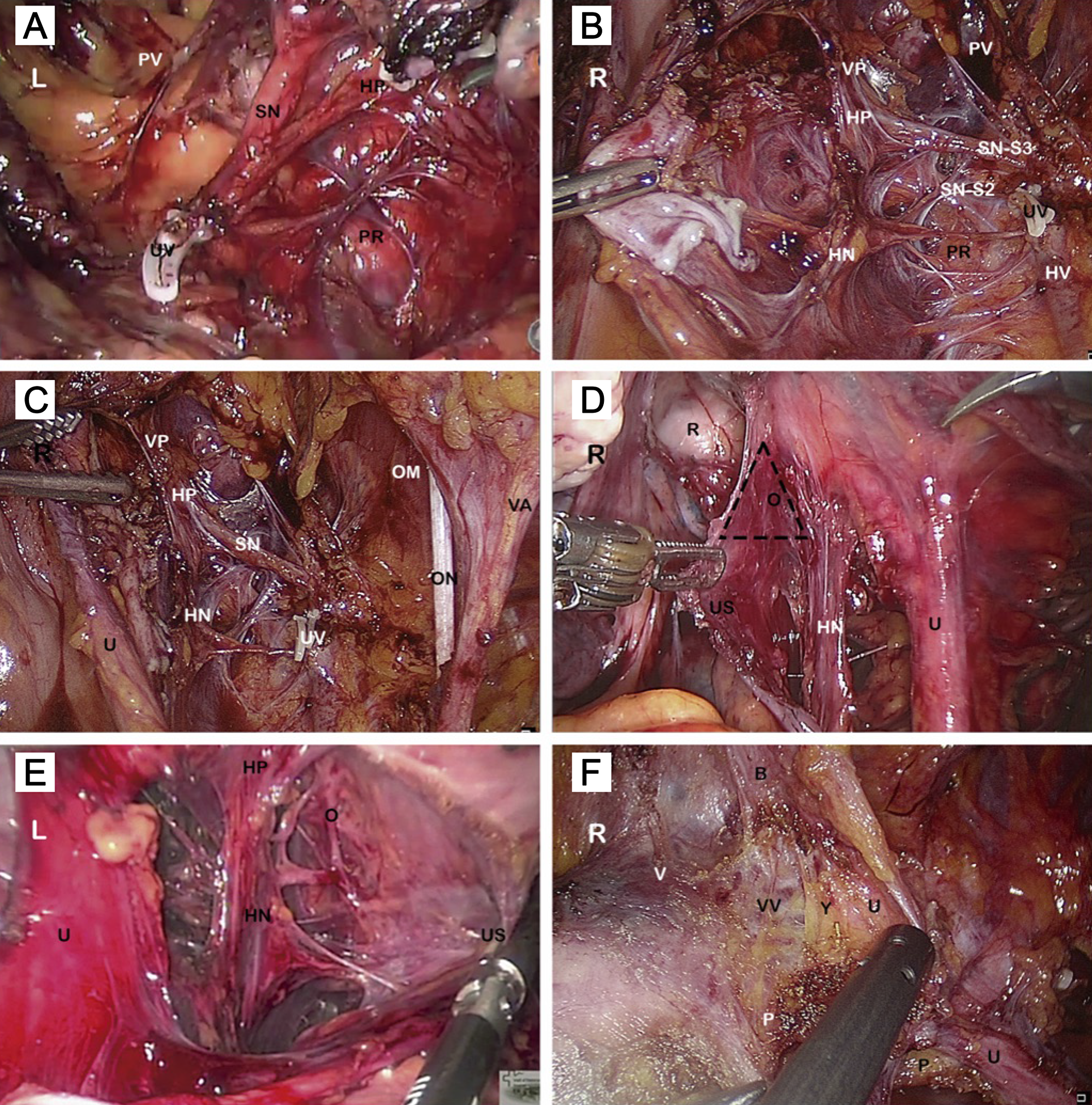 Nerve-sparing radical hysterectomy: Key steps.
