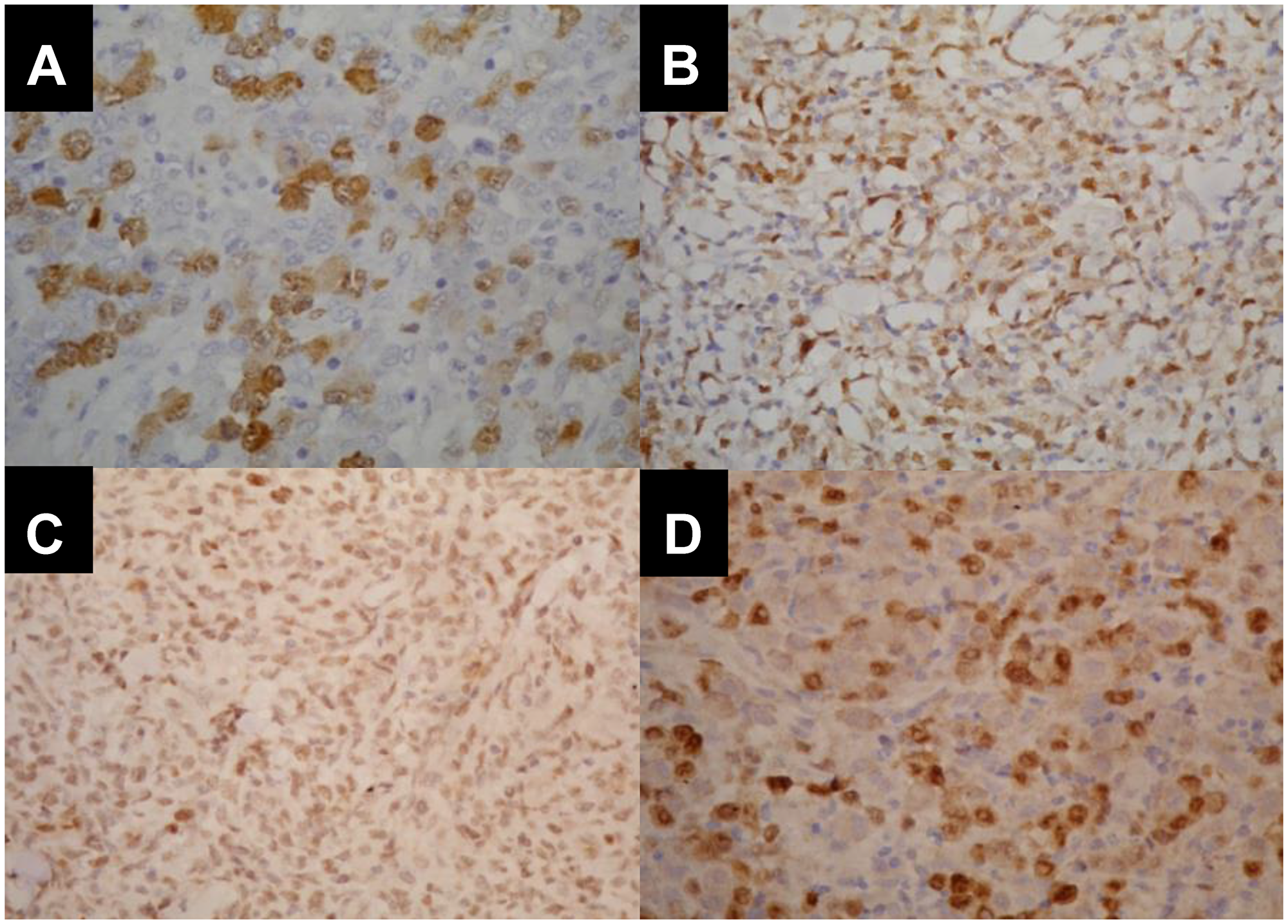 Immunohistopathological pattern of CCNA2, TOP2A, NFkB and CHEK1 expression in different histopathological subtypes of nodal PTCL