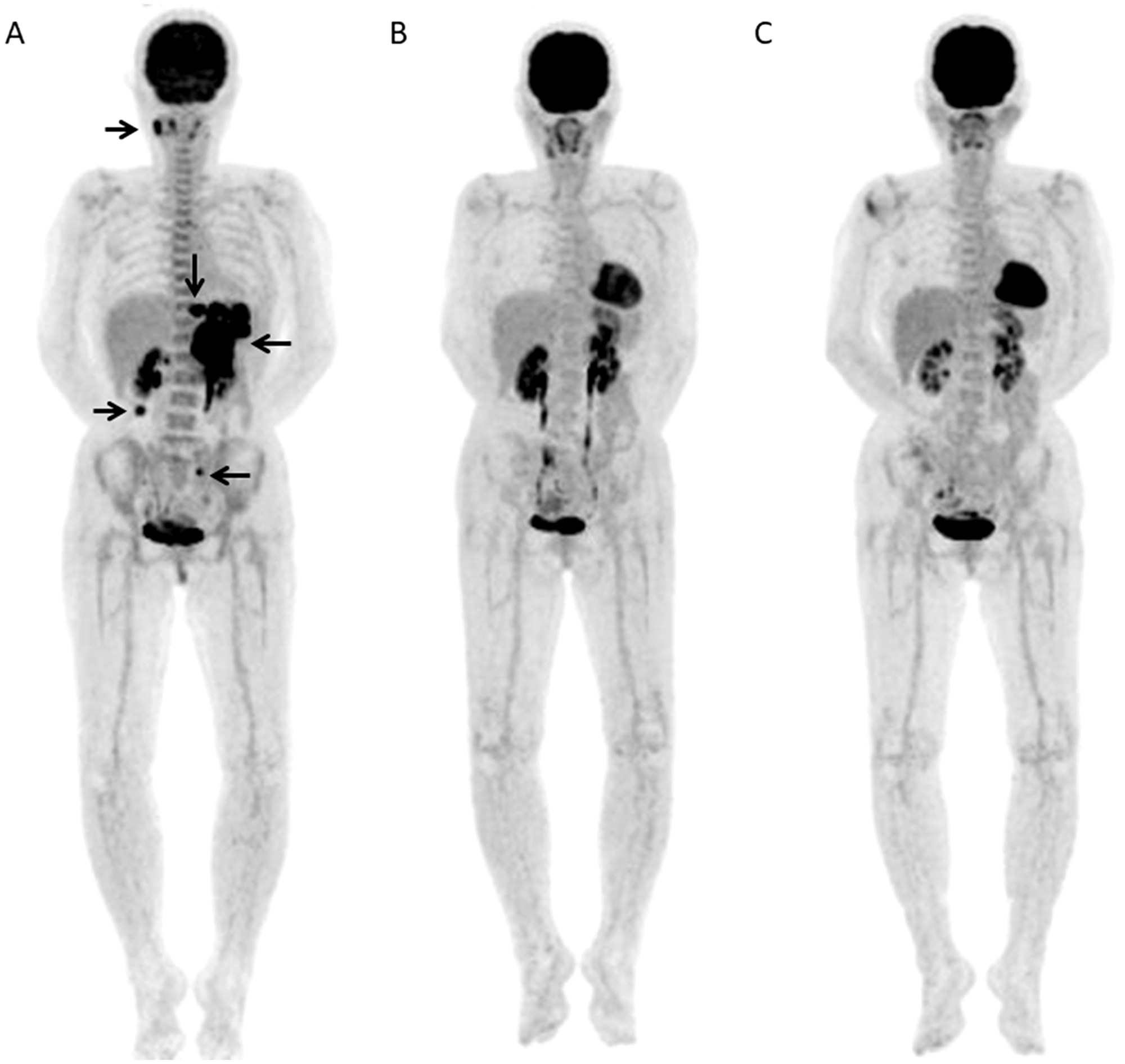 A 67-year-old female with DLBCL received 6 R-CHOP courses and no relapse was seen after 3.82 years