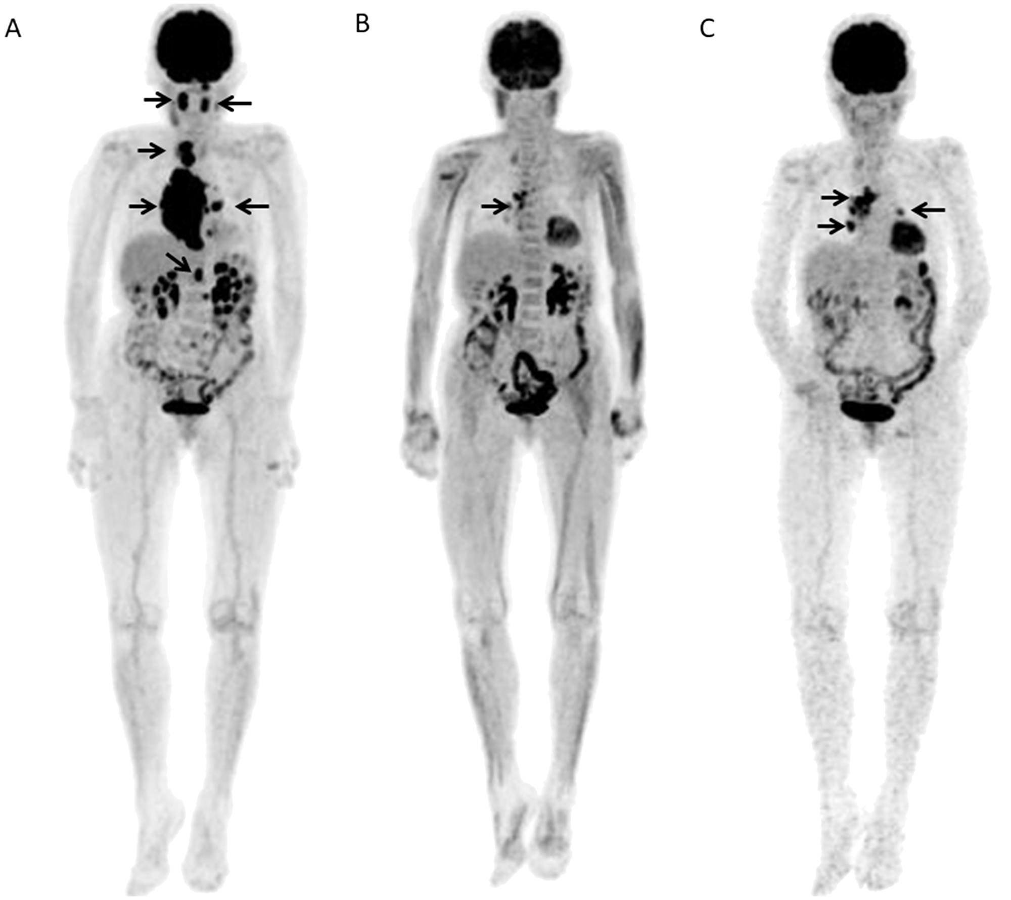 A 80-year-old female with DLBCL received 6 R-CHOP courses and then showed further progression at 0.41 years after the end of chemotherapy