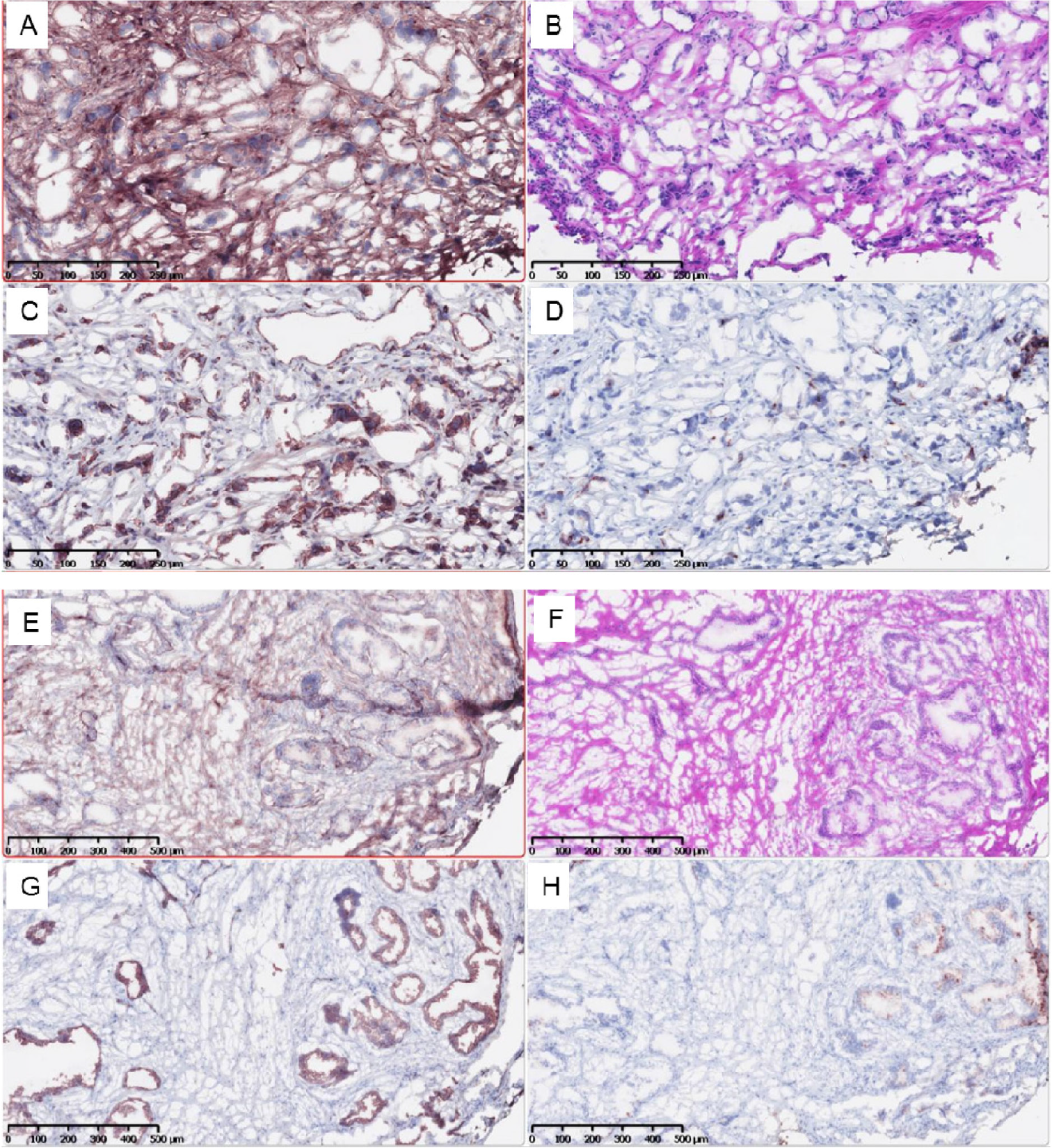 Lymph Nodes of Patient with osteoarthritis (top 4 images) and no osteoarthritis (bottom).