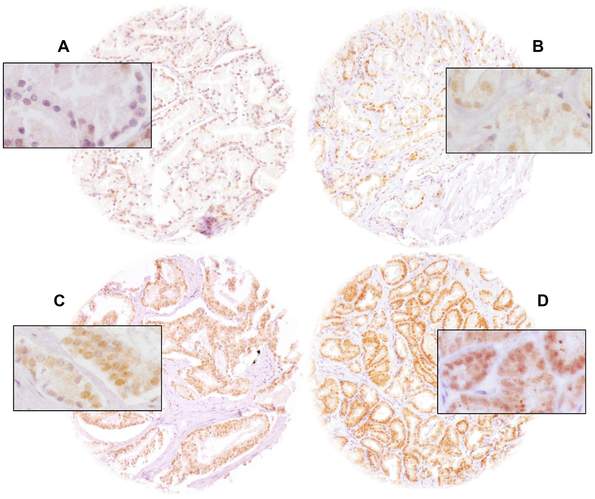 Representative pictures of prostate cancer with (A) negative, (B) weak, (C) moderate and (D) strong nuclear ELAC2 staining. Magnification was 100×, insets 400× and spot size 600 μm.