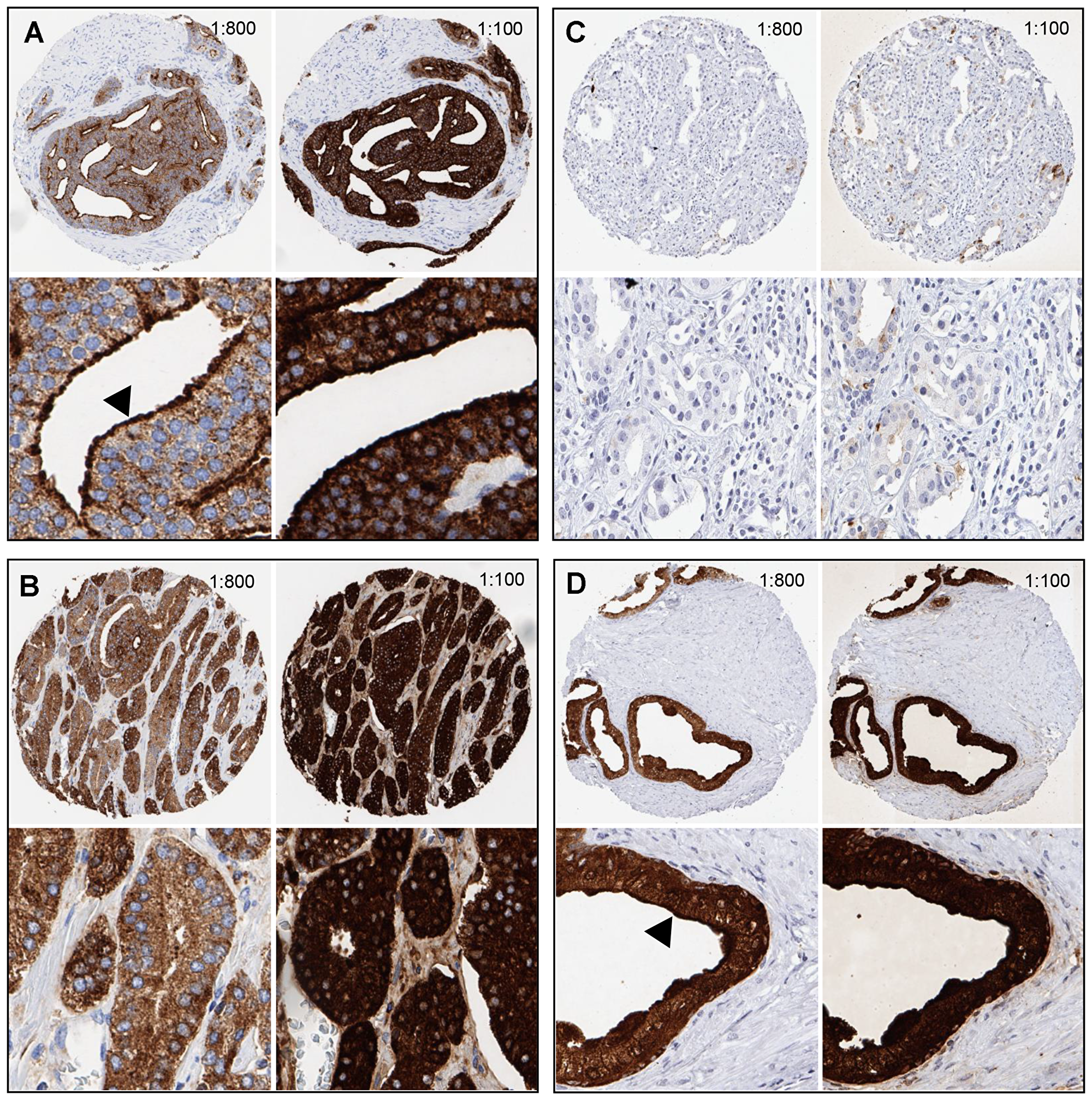 Examples of PSA immunostaining at two different antibody dilutions (1:100, 1:800) in prostate tissues