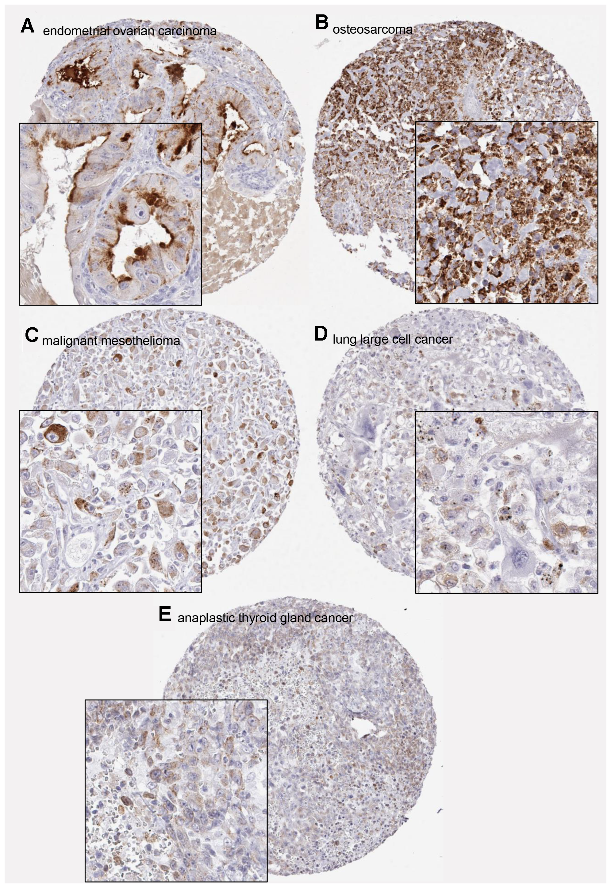Examples of positive PSA immunostainings in non-prostatic tumors