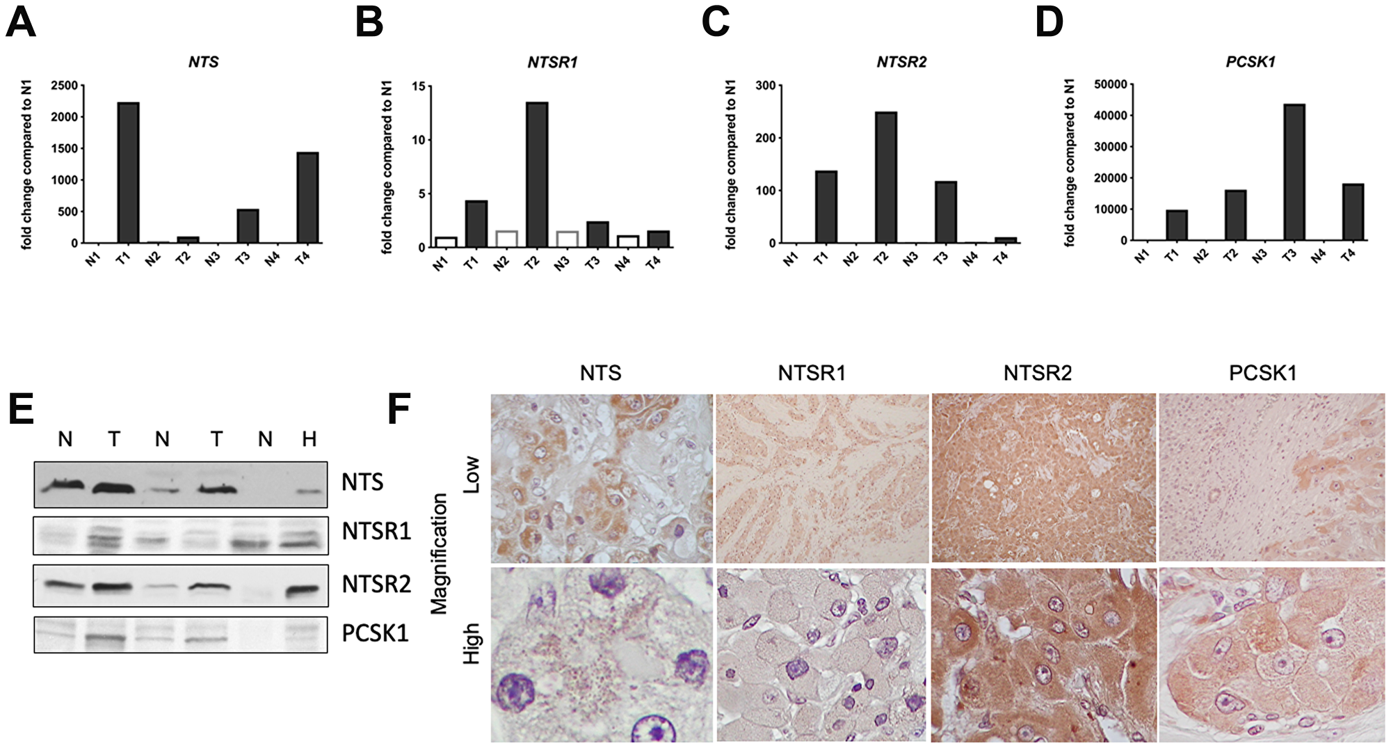 Neurotensin pathway mRNA and protein expression in FL-HCC