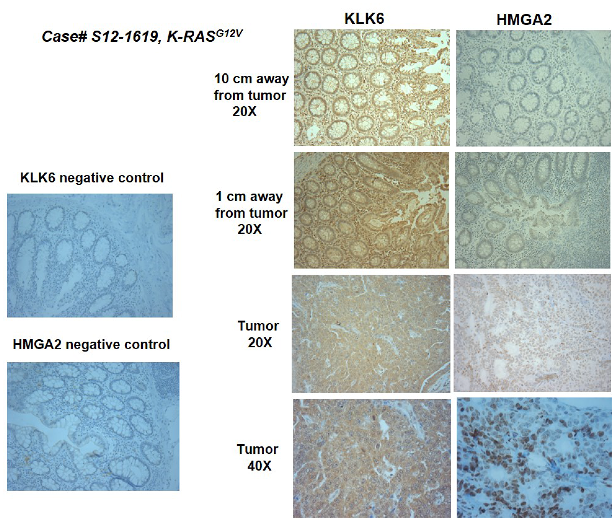 Representative images of KLK6 and HMGA2 IHC staining in the surgical material of a colon cancer patient