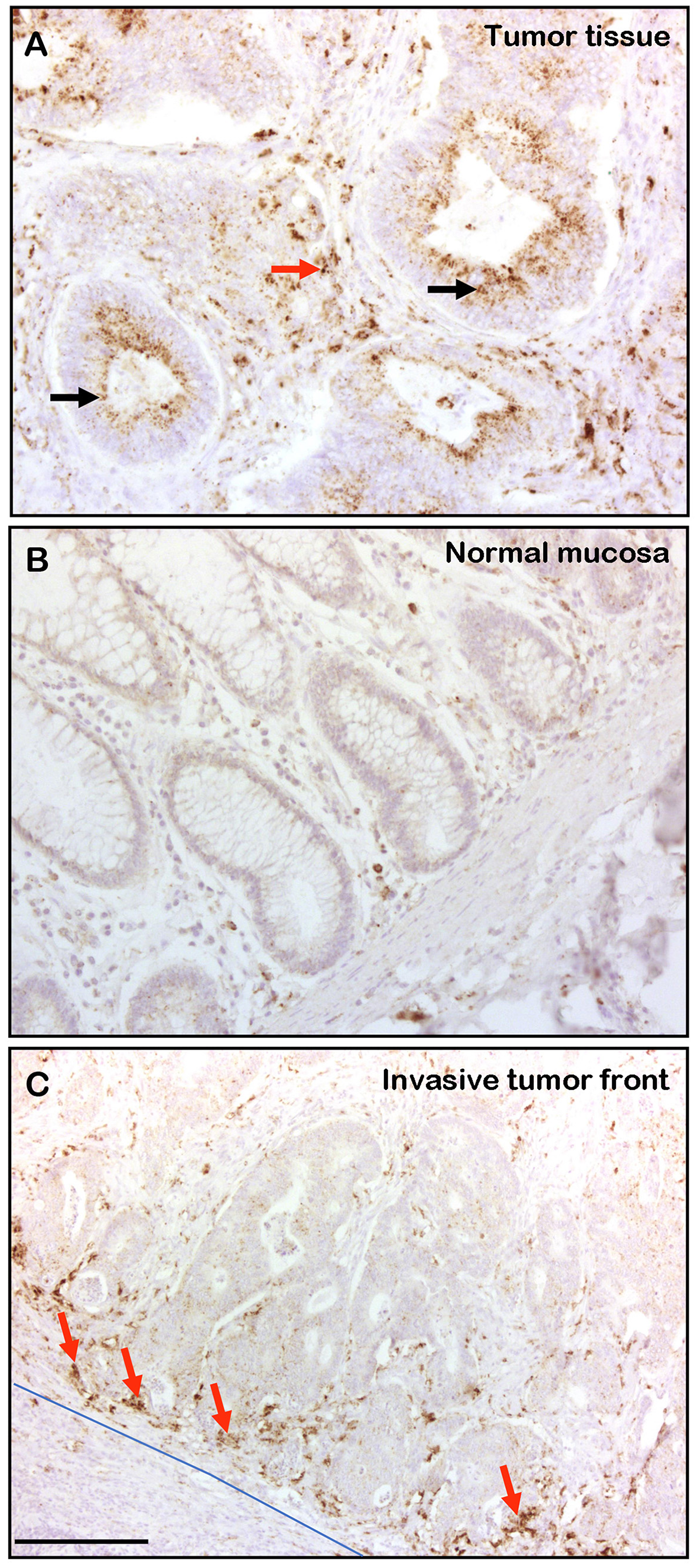 CTSD is expressed in human CRC tissue and in invasive areas of the stroma
