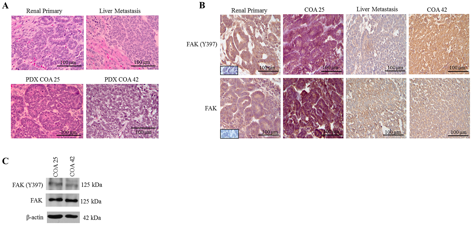 FAK in human Wilms tumor (WT) samples and patient derived xenografts (PDX)