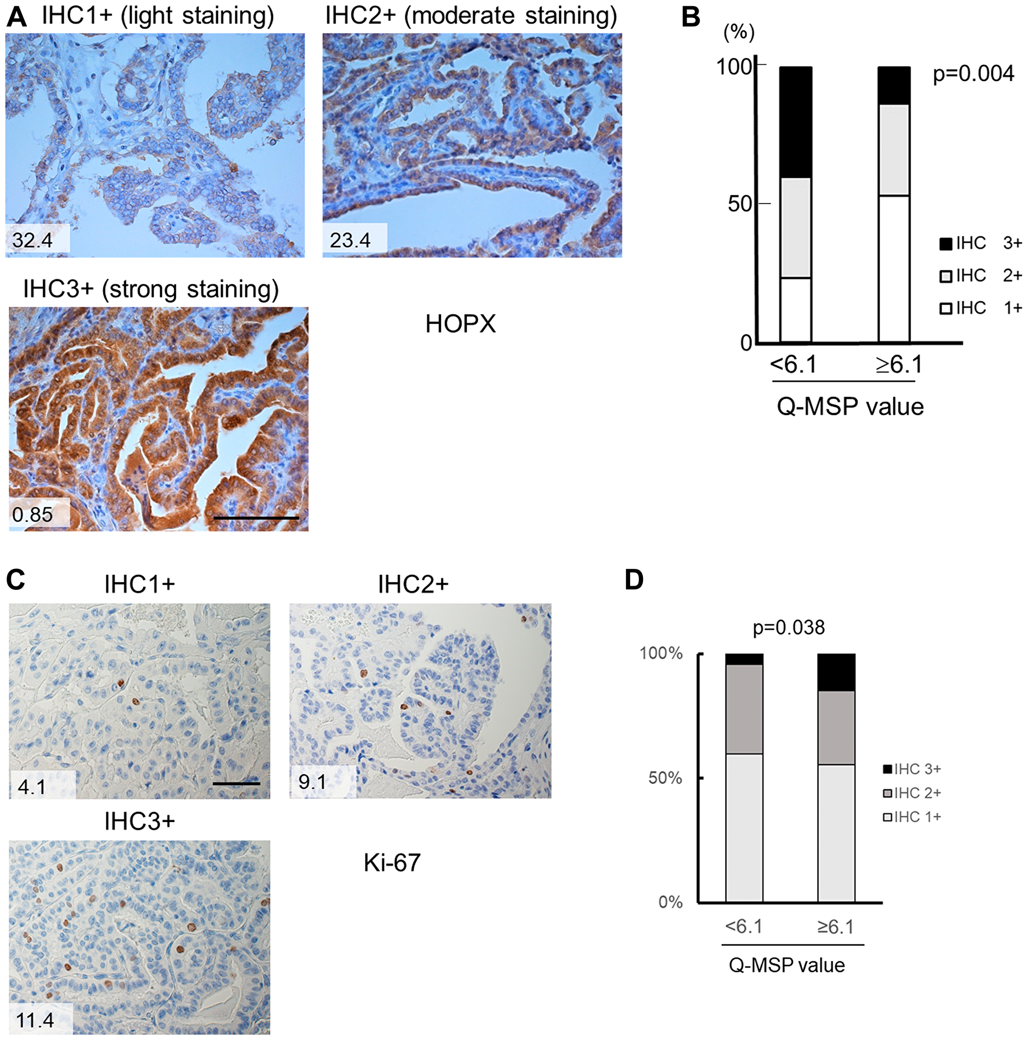 Immunohistochemistry of HOPX and Ki-67 in human primary PTC tissues