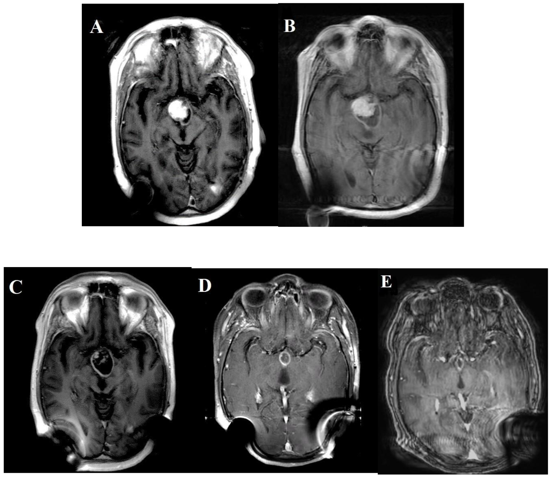MRI brain before BRAF inhibitor was introduced (both A & B)
