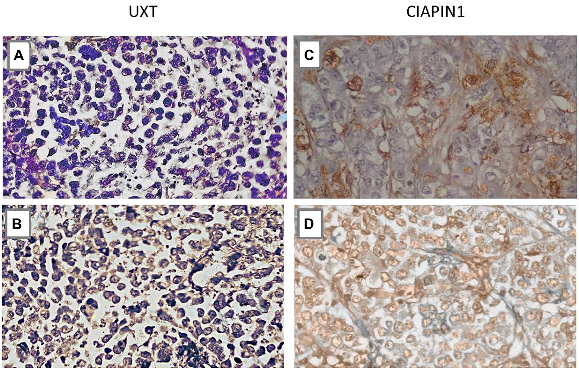 Immunohistochemistry analysis of the UXT and CIAPIN1 proteins in primary gastric tumor tissues of patients without metastasis (M0) and with metastasis (M1)