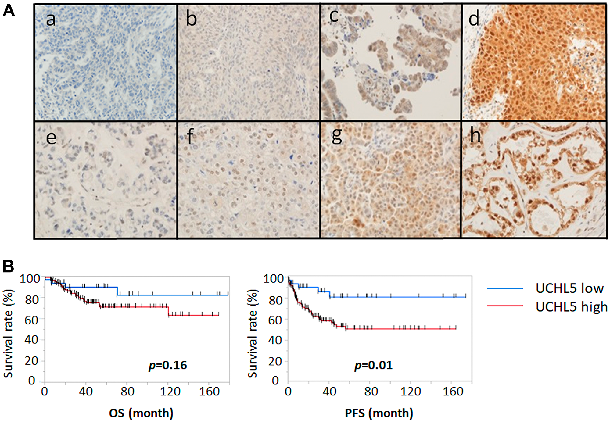 Immunohistochemical staining pattern of UCHL5 in ovarian cancer