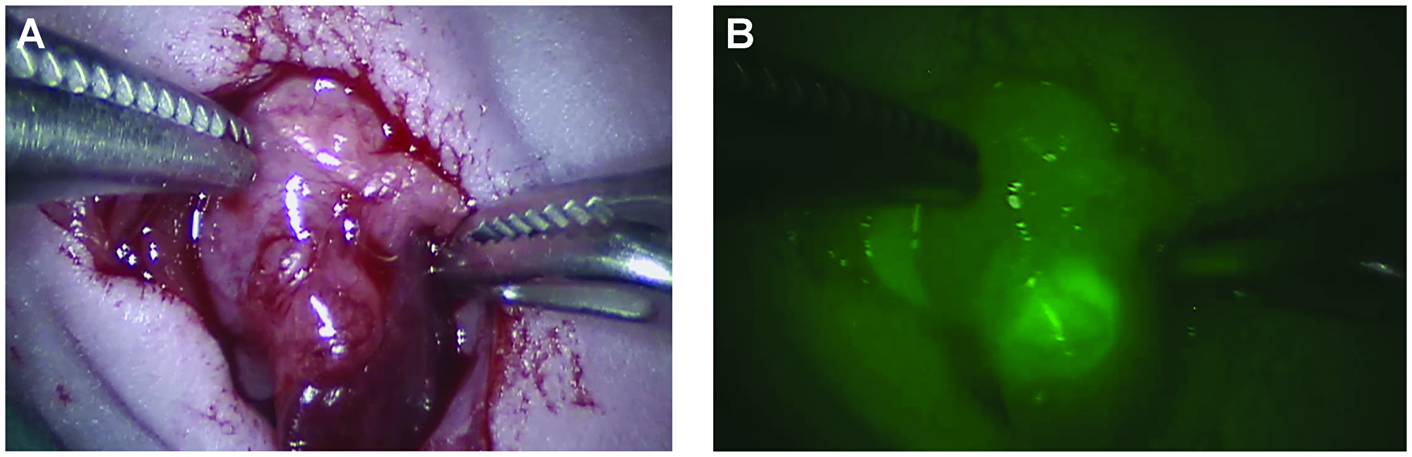 Images of a primary orthotopic pancreas human xenograft tumor as seen with the robotic Da Vinci® system