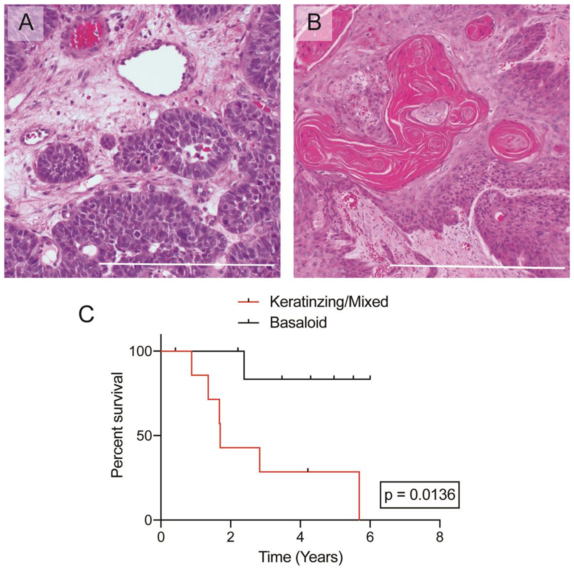 Histologic images of anal squamous cell carcinoma