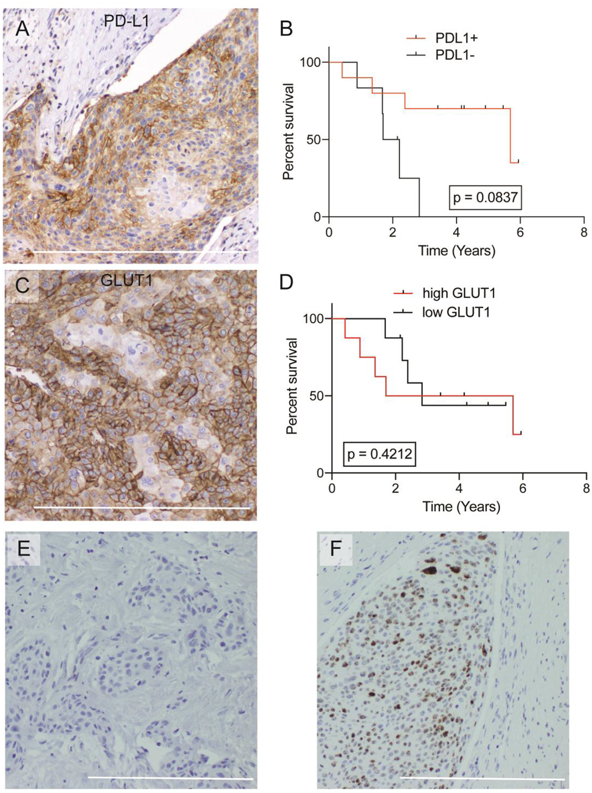 Overall survival analysis of GLUT1, PD-L1, and histologic architecture