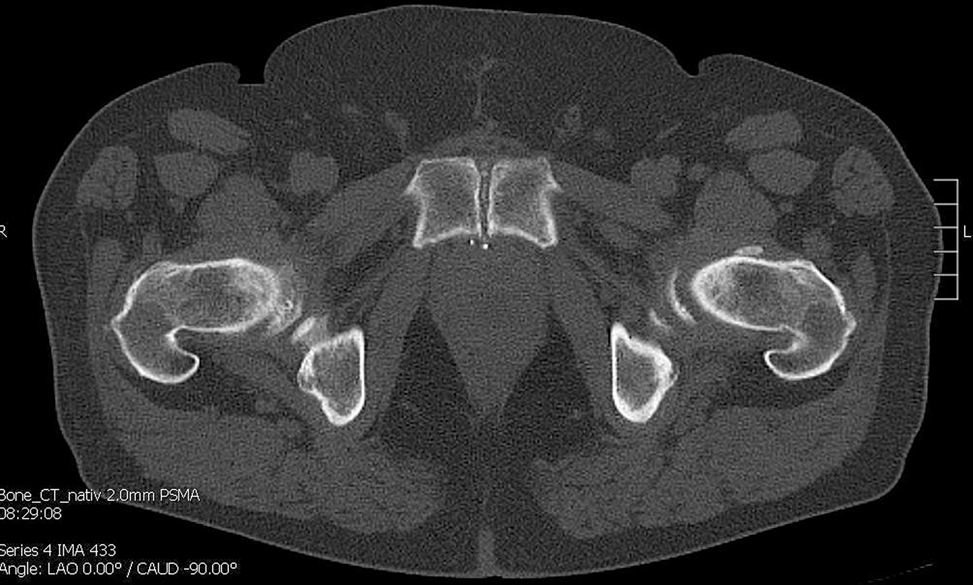 CT shows no bone metastasis in the symphyseal os pubis on the left
