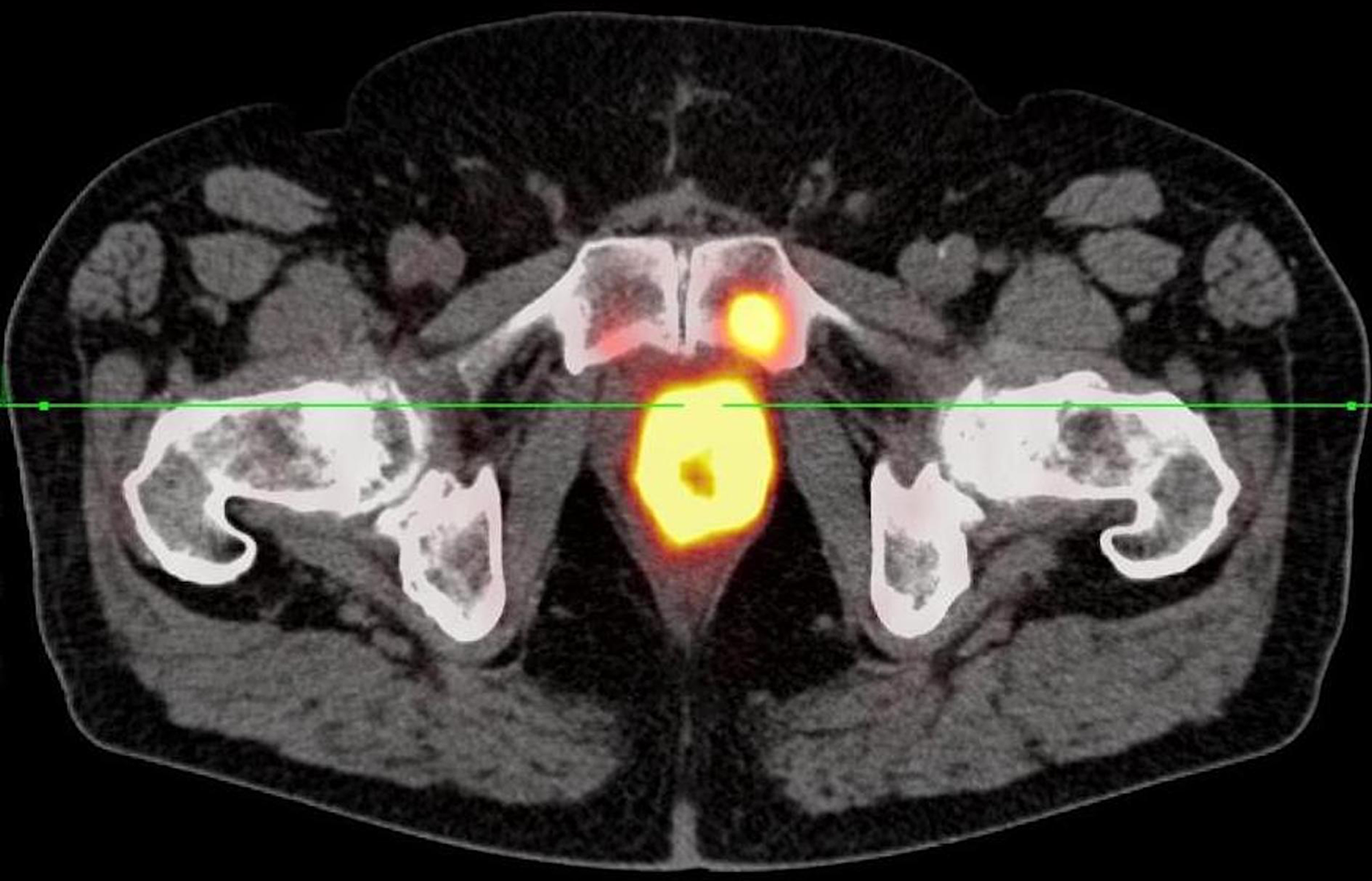 68Ga-PSMA-11 PET/CT shows a bone metastasis in the symphyseal os pubis on the left
