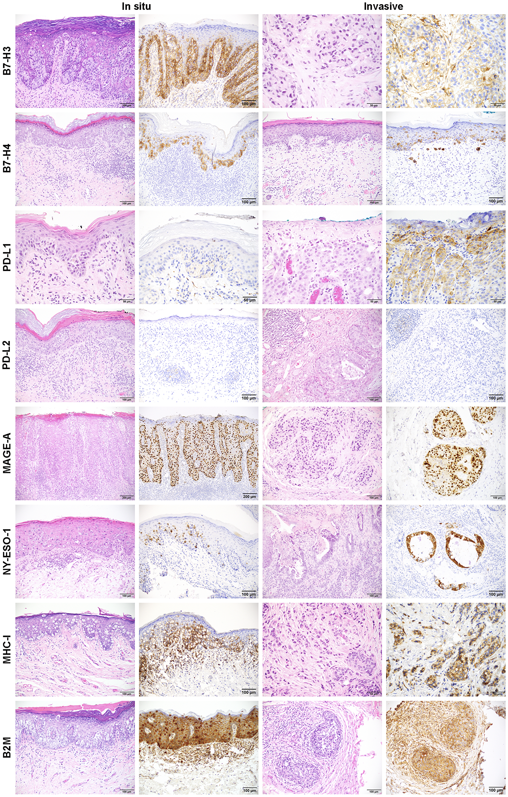 Representative images of immunohistochemistry for B7-H3, B7-H4, PD-L1, PD-L2, MAGE-A, NY-ESO-1, MHC-I, and B2M in in situ and invasive EMPD