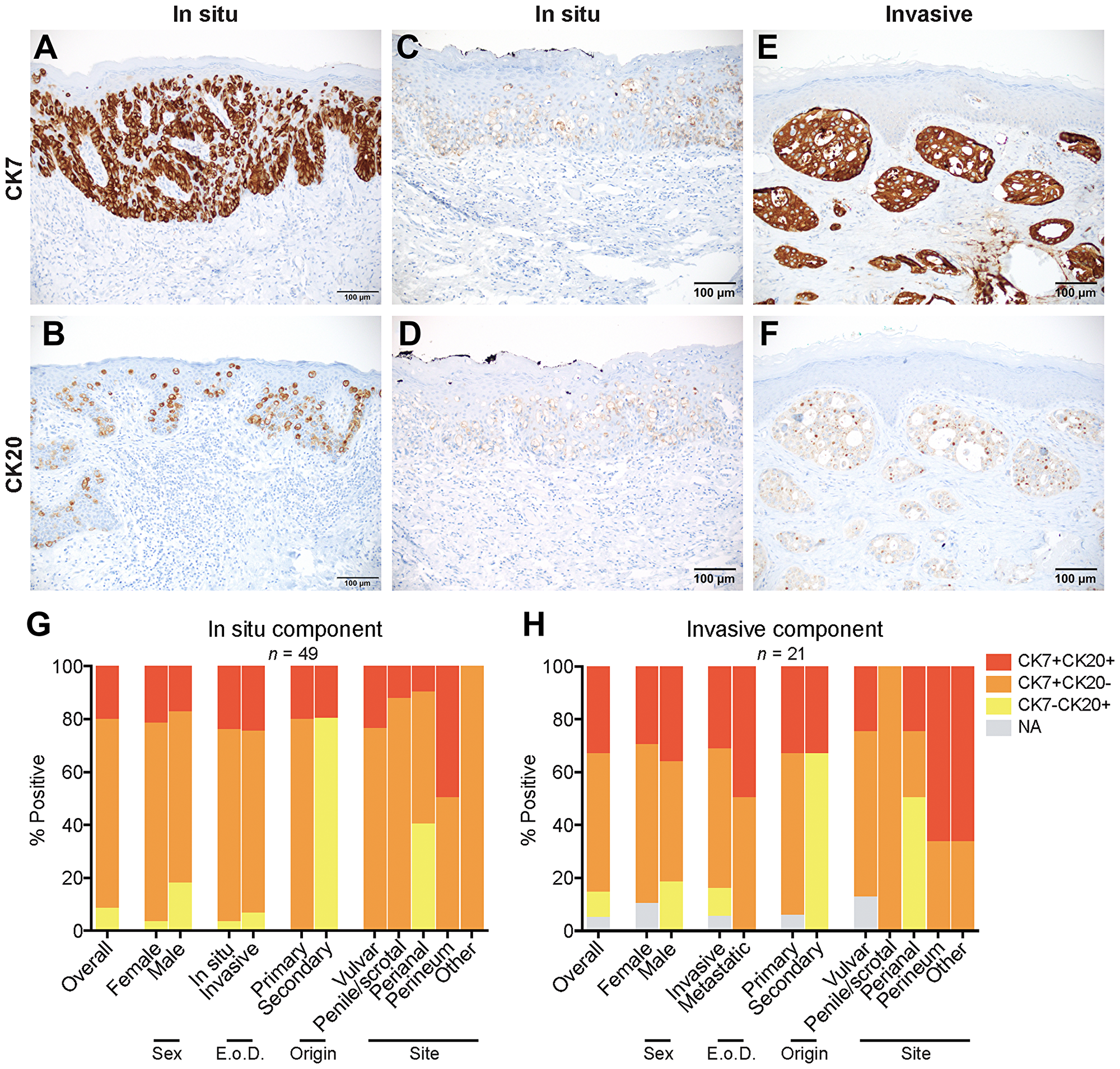 Expression and coexpression of CK7 and CK20 in EMPD