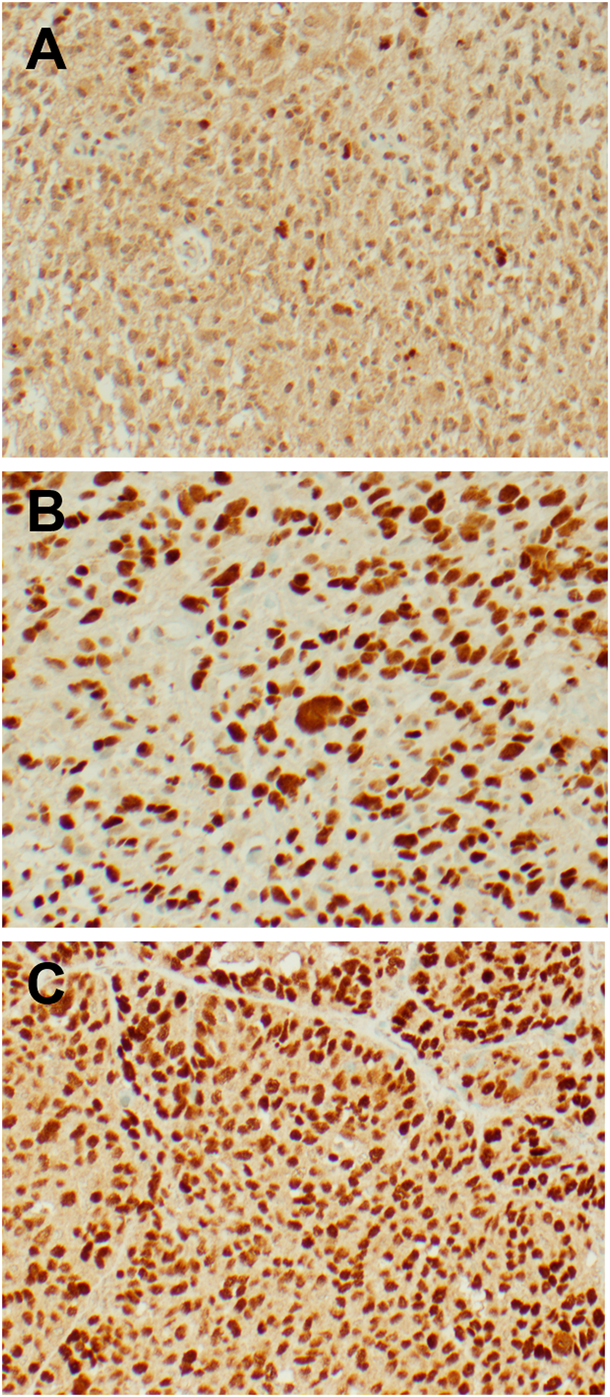 Representative IHC images from freshly resected tumor samples
